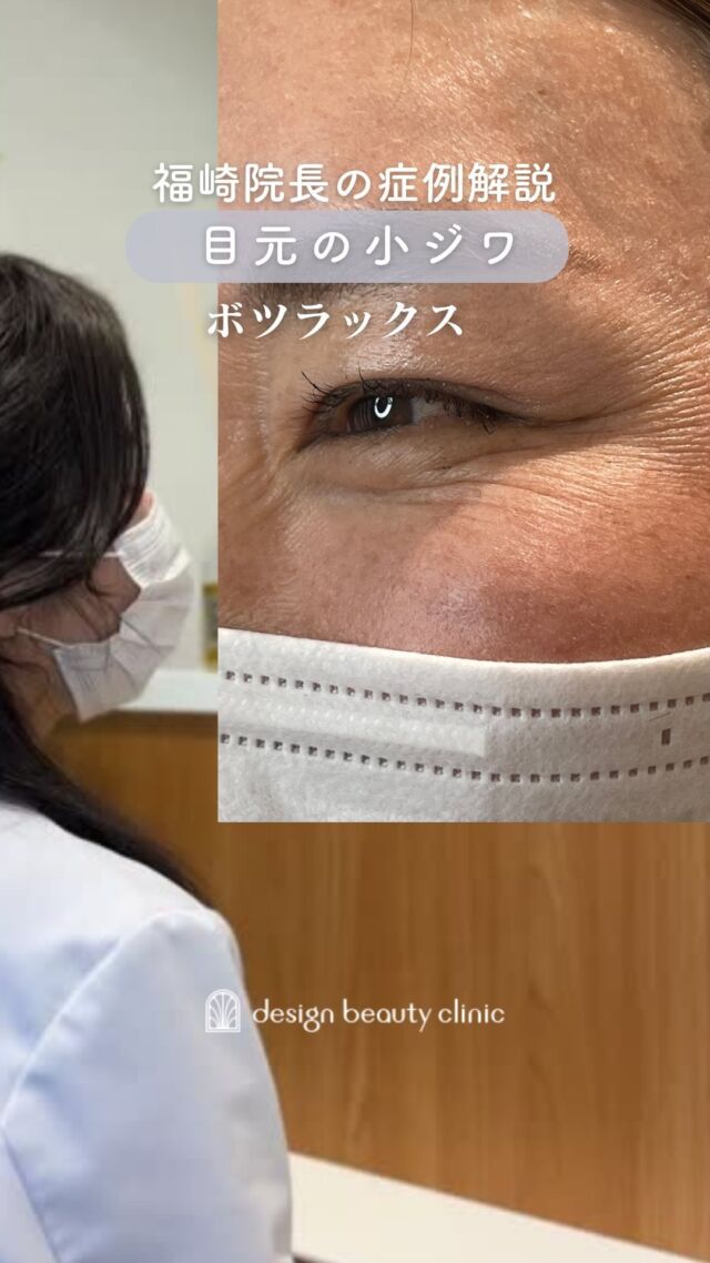 目元の小ジワについて
福崎院長が症例解説しています🧑‍⚕️✨

施術1ヶ月後の様子では思いっきり笑っても小じわにならず、且つ、ナチュラルな笑顔になっています😊👍

～ボツラックス注射がおすすめな方～
・顔の表情ジワが気になる
・シワを予防したい

★額or眉間or目尻or目の下or顎
☆各：6,000円（税込）
・カウンセリング+施術時間：30分
・施術中の痛み：チクっとした痛みあり
（※個人差あり）
（※表面麻酔希望の場合：+3,000円）
・ダウンタイム：内出血がでる場合もありますが、徐々に落ち着きます。
ボトックスは熱に弱い為、薬剤が安定するまでの１週間は血行を促進させるサウナや岩盤浴などは控えてください。
・施術後のメイク：施術部位を避ければ当日から可能
・効果：表情ジワの改善、エラの改善、小顔効果、肩こり改善、多汗症の改善

-----------------------------------

ACCESS：大阪府大阪市北区茶屋町15-8
茶屋町ビル2階
TEL：06-6743-4652
営業時間：10時〜17時
(最終受付時間：16時)
お問合せ受付時間：10時〜19時

#美容皮膚科 #美容外科 #美容クリニック #ボツラックス #ボツリヌストキシン #ボトックス #目元のシワ #目元のシワ改善