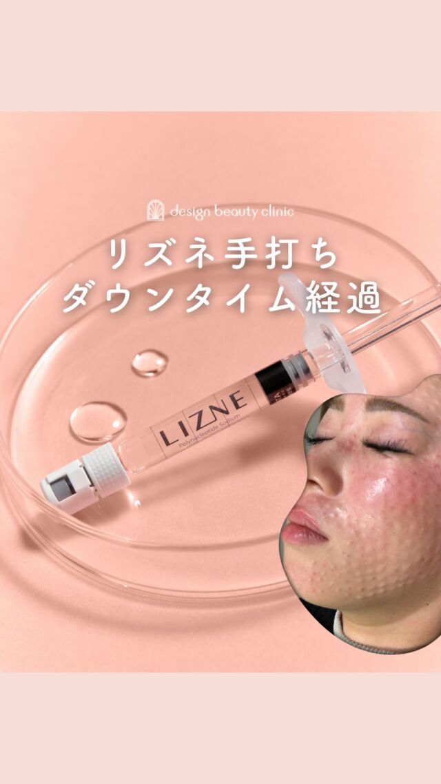 ✨
大人気のリズネ💉
ドクターが注射でお顔全体に手打ちした時のダウンタイムレポートです😊

術直後は凸凹したお肌も
時間の経過と共に落ち着いていく様子が
わかります👍

リズネドクター手打ちをされる方は
エレクトロポレーションも同日に施術することを
オススメいたします😊
鎮静のためにエレクトロポレーションをすることで
お痛みやダウンタイムの軽減につながります👍✨

【リズネ】
リズネは老化や損傷した肌細胞の再生を促進して
内側からハリ、ツヤ、うるおいの肌に導く
肌育注射です💉
リジュランの後発品でお値段を
抑えつつ効果を発揮します❤️

■水光注射（全顔2cc）
初回：32,000円
初回（日曜日限定）：30,000円

通常：41,000円
平日3回：96,000円
全日3回：106,000円

■ドクター手打ち（全顔2cc）
通常：57,000円

※表示価格は全て税込みです。
※別途麻酔代3,000円
※ご希望により9,800円でボツラックスオプションもつけられます。

————————————

ACCESS：大阪府大阪市北区茶屋町15-8
茶屋町ビル2階
TEL：06-6743-4652
営業時間：10時〜17時
(最終受付時間：16時)
お問合せ受付時間：10時〜19時

美容皮膚科 #美容外科 #美容クリニック #ジュベルック #リジュラン　 #リズネ #サーモン注射 #水光注射 #ハイコックス #韓国美容 #designbeautyclinic #肌育注射 #シワ #ニキビ跡 #ヒアルロン酸