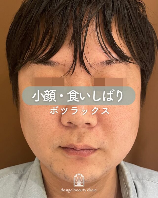 💉✨

男性の方で寝ているときの
歯ぎしりで悩まれている方！！
そのまま放置していると、どんどん
咬筋が発達してしまい、エラが発達
することで、お顔が大きくなってしまいます💦
また、歯ぎしりは食いしばりによるもの
なので、歯にも悪影響+しっかりとした
睡眠がとれていないなども💦

ボツラックス注入は整形だ！と
抵抗のある男性の方も多いようですが、
１度施術すると筋肉が緩んでくれるので
とても楽になったと仰います🎵

・エラが張っていて顔が大きいのが悩み･･･
・睡眠時に歯ぎしりで悩んでいる･･･
・食いしばりのせいで頭痛がする･･･
・小顔になりたい！！
などのお悩みにはエラボツラックス✨

施術中の動画や術前のお写真も
投稿にございますのでご覧ください♪
術後のお写真は1ヶ月後に撮影し、
別で投稿致しますのでお楽しみに♪♪

◇エラボツラックスの効果は？
日頃から歯ぎしりや食いしばりをして
しまう方は、その度に歯に体重の1.5倍
近い力が加わっていると言われています。
この食いしばりなどの癖により、
頬にある咬筋が過剰に発達してしまう
ことで、エラが張ってしまうのです。
ボツラックスを注射すると、顎の強い筋肉を
緩めることができるので、歯ぎしりや
食いしばりを緩和することができ、また
症状の1つでもある肩コリや頭痛が解消
され、エラの張りや首のむくみも解消し、
顔全体がすっきりとした印象になります。

～ボツラックスの効果持続期間～
個人差はありますが3～4ヶ月程度と
されています。
注射を行ってから2〜3日程度で
効果があらわれはじめ、徐々に
シワや多汗症などが改善されて、
徐々に筋肉が緩和し、
1ヶ月かけて身体に馴染んでいきます。

3〜4ヶ月をピークに徐々に効果が
薄れていき、治療から6ヶ月経つ頃
には効果もなくなっていることが
ほとんどです。
ボツラックス注射の効果を維持する
ために、4〜6ヶ月に一回定期的に
施術を受けることがお勧めです。

～ボツラックス注射がおすすめな方～
・エラが気になる
・フェイスラインをスッキリさせたい
・顔の表情ジワが気になる
・マッサージを受けても肩こりが治らない
・首から肩の華奢なラインに憧れる
・ワキガや多汗症で悩んでいる

■ボツラックス
ボツラックス（Botulax）は、韓国のHugel社が製造したA型ボツリヌス毒素を有効成分とする薬剤です。
承認状況：国内未承認
入手経路：PRSS社より入手
国内の承認医薬品などの有無：同一の成分や性能を有する他の国内承認医薬品等はありません
諸外国における安全性等に係る情報：韓国の食品医薬品安全庁（KFDA）

★エラ
☆Single：10,000円
☆double：16,000円
☆triple：25,000円
・カウンセリング+施術時間：30分
・施術中の痛み：チクっとした痛みあり
（※個人差あり）
（※表面麻酔希望の場合：+3,000円）
・ダウンタイム：内出血がでる場合もありますが、徐々に落ち着きます。
ボツラックスは熱に弱い為、薬剤が安定するまでの１週間は血行を促進させるサウナや岩盤浴などは控えてください。
・施術後のメイク：施術部位を避ければ当日から可能
・効果：表情ジワの改善、エラの改善、小顔効果、肩こり改善、多汗症の改善

⚠️DMでのお問い合わせはお受けしておりません
お問い合わせは、クリニックへ直接お電話をお願いいたします🌱

————————————

ACCESS：大阪府大阪市北区茶屋町15-8
茶屋町ビル2階
TEL：06-6743-4652
営業時間：10時〜17時
(最終受付時間：16時)
お問合せ受付時間：10時〜19時

#美容皮膚科 #美容外科 #美容クリニック #ボツラックス #ボトックス #しわ #エイジング #アンチエイジング #小顔