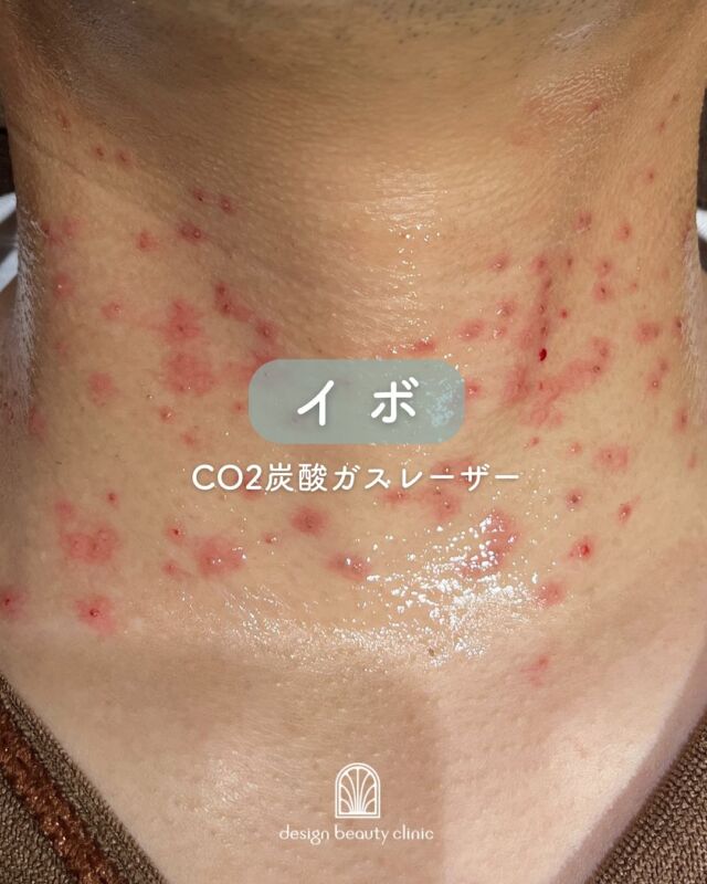 ✨

首のイボにお悩みの患者様、
施術前▶️4ヶ月後の症例です👩‍⚕️

首にイボが複数個あり、
目立ってしまうことがお悩みとの
ことでした。

施術直後から3日ほどは
赤みが目立ちますが、
1週間後くらいからだんだんと赤みが
目立たなくなっていき、
4ヶ月後には綺麗になり、元々首に
イボなんて無かったようですね👏✨

※ダウンタイム等には個人差がございます。

施術を検討されている方は是非
ご予約くださいませ♡

～CO2ﾚｰｻﾞｰってなに？～
もともと皮膚には水分が多く
含まれており、CO2レーザーを
照射することで細胞内の水分が
反応し、熱エネルギーを発生
させます。この熱エネルギーが
水分を瞬間的に蒸散することで
皮膚が削られ、イボが除去
されます。さらに、レーザーを
照射した部位周辺の血管は
熱凝固作用で瞬時に固まるため、
出血の心配はほとんどありません。
また、CO2レーザーの蒸散作用は
皮膚の表面のみで、深い層まで
届かないので除去後の創傷治癒も
比較的早いというのが特徴です。

CO2ﾚｰｻﾞｰの注意点として、
イボの大きさや深さによって
1度の施術で取り切れない
可能性あります。またその場合の
再施術は、前回の施術から
3カ月以上空ける必要が有り、
再発するリスクもあります。
術後はしっかりと日焼け対策を
行ってください。

☆1～5個：5,500円 / 個
☆6～10個：11,000円 / 個

☆軟膏1本：700円
☆麻酔代別途3000円

・カウンセリング＋施術時間：約１時間
・施術中の痛み：表面麻酔を使用する為、痛みはほぼ無し。
　（※個人差あり）
・ダウンタイム：２週間程度の間、軟膏塗布必要
・施術後のメイク：患部を避けて当日からOK

⚠️DMでのお問い合わせはお受けしておりません
お問い合わせは、クリニックへ直接お電話をお願いいたします🌱

————————————

ACCESS：大阪府大阪市北区茶屋町15-8
茶屋町ビル2階
TEL：06-6743-4652
営業時間：10時〜17時
(最終受付時間：16時)
お問合せ受付時間：10時〜19時

#美容皮膚科 #美容外科 #美容クリニック #ほくろ #ほくろ取り #イボ #イボ取り #炭酸ガスレーザー #co2炭酸ガスレーザー