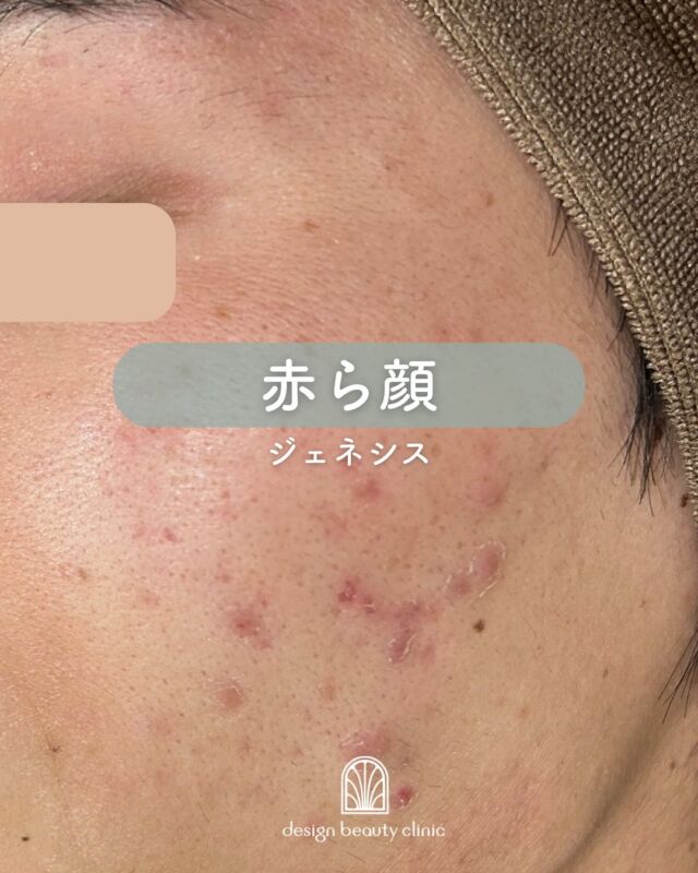 ✨

ジェネシスレーザーの症例です✨
この方はニキビの炎症による
赤み・色素沈着などお悩みです。
ジェネシスﾚｰｻﾞｰはマイルドな
レーザー施術になりますので
回数は必要になりますが、
1回の施術でもキメが整い、頬に
艶玉ができているのが分かります👏

この方はジェネシス施術後に
エレクトロポレーションも組み合わせで
行い、相乗効果が高くなっていますね👌

ジェネシスは施術中もお痛みなどはなく
温かい熱のシャワーを浴びているような
体感も人気の理由の一つです🎵

～ジェネシスって何？～
ジェネシスは、１施術で何役も
こなす多彩な効果を持つため、
いくつかの複合的な肌のお悩みに
アプローチ出来ます。
主な効果はこちらになります。

◇レーザーピーリング効果により、
悪化したニキビやニキビ跡の改善を
促し、毛穴の引き締めにも効果的
◇ターンオーバーの乱れを正常な
状態に近づける事によって、色素沈着の
改善や、シミのやくすみの改善
◇真皮層に位置する微小血管を加熱し、
血管壁や赤血球を破壊することによって、
赤ら顔や毛細血管拡張症の改善
◇真皮層に働きかけることで
コラーゲンの生成を促し、ハリのある
きめ細やかな肌になる

複数回にわたり継続することで
徐々に肌質を改善していく治療のため、
定期的な治療をお勧めします。
症状改善がみられたあとも、
メンテナンスのために受けて頂く
ことで、若々しい肌へと導きます。

マイルドなレーザーのため、
体感としては温かい熱のシャワーを
浴びているような感覚で、照射時は
痛みがほとんどありません。

～ジェネシスがおすすめな方～
・赤ら顔にお悩みの方
・ニキビ跡の赤み、色素沈着にお悩みの方
・アトピー性皮膚炎による色素沈着でお悩みの方
・アンチエイジング

☆初回3000shot：7,800円
☆通常3000shot：10,800円
☆初回6000shot：13,600円
☆通常6000shot：18,800円
・カウンセリング＋施術時間： 45分～60分
・施術中の痛み：ほとんどなし
・ダウンタイム： 赤みや熱感、痒み等の肌荒れが生じる場合あり
・施術後のメイク：当日からOK
・効果：赤ら顔、ハリツヤ、ニキビ痕の赤み、ニキビ痕の色素沈着、肌のキメなどの肌質改善

⚠️DMでのお問い合わせはお受けしておりません
お問い合わせは、クリニックへ直接お電話をお願いいたします🌱

-———————————

ACCESS：大阪府大阪市北区茶屋町15-8
茶屋町ビル2階
TEL：06-6743-4652
営業時間：10時〜17時
(最終受付時間：16時)
お問合せ受付時間：10時〜19時

#美容皮膚科 #美容外科 #美容クリニック #美肌 #女医 #ニキビ跡 #ニキビ痕 #保湿 #エイジングケア #肌質改善