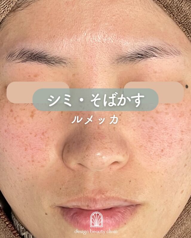 ✨

当院で人気施術の1つ！
ルメッカの症例です♪

1回目と3回目ではそばかずも綺麗になり、
肌の赤みも落ち着き、トーンアップも🙆‍♀️✨

施術中は照射の都度、お客様に
お痛みなどを確認しながら照射して
いきますので、ご安心ください♡

ルメッカは施術直後しみが
濃くハッキリしますが
しっかりと反応しているので
一時期濃くなります。
その後反応したシミが瘡蓋、または
薄皮がめくれるなどして回数を
重ねる毎に薄くなっていきます♪

〜 ルメッカってなに？ ～
シミやそばかす、赤ら顔を含めた
皮膚の若返りを目的とした
光治療（IPL）です。
お肌に有効な光エネルギーを当てる
ことによりコラーゲンの生成を促し
ハリや潤いを与え、
ターンオーバーを促進し、様々な
肌トラブルの改善・解消に有効的な
施術です。
光と熱の作用によりコラーゲンや
エラスチンの再生が促される為、
肌全体の若返りが期待できます。

ルメッカは従来のIPLとは違い、
高い出力での照射が可能で、
反応も良いため少ない回数で
効果を実感することが可能です。
シミが濃く反応したところは、
ターンオーバーにより10日程
かけて薄くなります。
照射後はお肌のトーンが1トーン
上がるので、満足感が高いのも
この施術のメリットです。

シミが出来る原因としては
様々な要因が考えられるため、
治療後もシミが増えない肌作りを
していくために、日頃の生活習慣
の改善やスキンケアの見直しは
必須となります。
インナーケアの手助けになる
サプリメント、スキンケアも数多く
取り扱っておりますので、
お気軽にご相談ください。

☆全顔初回：12,800円
☆全顔通常：20,000円
・カウンセリング＋施術時間：約１時間
・施術中の痛み：
個人差がありますが、我慢できる程度です。
・ダウンタイム：２､３日～１週間程度の赤みや
ひりつきが生じる場合あります。
（個人差があります）
・施術後のメイク：当日からOK
・効果：シミ・そばかす・赤ら顔

⚠️DMでのお問い合わせはお受けしておりません
お問い合わせは、クリニックへ直接お電話をお願いいたします🌱

————————————

ACCESS：大阪府大阪市北区茶屋町15-8
茶屋町ビル2階
TEL：06-6743-4652
営業時間：10時〜17時
(最終受付時間：16時)
お問合せ受付時間：10時〜19時

#美容皮膚科 #美容外科 #美容クリニック #美肌 #女医 #ピーリング #美白 #アンチエイジング #シミ取り #レーザートーニング #肌質改善 #しみ　#ルメッカ #デザインビューティークリニック