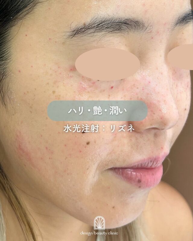 ✨
大人気のリズネ💉
こちらは水光注射による施術の症例です💉✨

術直後は赤みと凸凹したお肌ですが、
比較的リズネは赤みなども落ち着くのが
早く、ダウンタウンが苦手な方でも
挑戦しやすいかと思います👍
※個人差はございます。

施術後は鎮静のためにエレクトロポレーション
など組み合わせることで、
お痛みやダウンタイムの軽減にもつながるので
オススメですよ👍✨

〜リズネ〜
リズネは老化や損傷した肌細胞の再生を促進して
内側からハリ、ツヤ、うるおいの肌に導く肌育注射です💉
リジュランの後発品でお値段を
抑えつつ効果を発揮します❤️

■水光注射（全顔2cc）
初回：32,000円
通常：41,000円
3回コース：96,000円

■ドクター手打ち（全顔2cc）
通常：57,000円

※表示価格は全て税込みです。
※別途麻酔代3,000円
※ご希望により9,800円でボツラックスオプションもつけられます。

■リズネ
承認状況：国内未承認
入手経路：ARM社より入手
国内の承認医薬品などの有無：同一の成分や性能を有する他の国内承認医薬品等はありません
諸外国における安全性等に係る情報：韓国の食品医薬品安全庁（KFDA）の承認びCE認証

————————————

ACCESS：大阪府大阪市北区茶屋町15-8
茶屋町ビル2階
TEL：06-6743-4652
営業時間：10時〜17時
(最終受付時間：16時)
お問合せ受付時間：10時〜19時

⚠️DMでのお問い合わせはお受けしておりません
お問い合わせは、クリニックへ直接お電話をお願いいたします🌱

美容皮膚科 #美容外科 #美容クリニック #ジュベルック #リジュラン　 #リズネ #サーモン注射 #水光注射 #ハイコックス #韓国美容 #designbeautyclinic #肌育注射 #シワ #ニキビ跡 #ヒアルロン酸