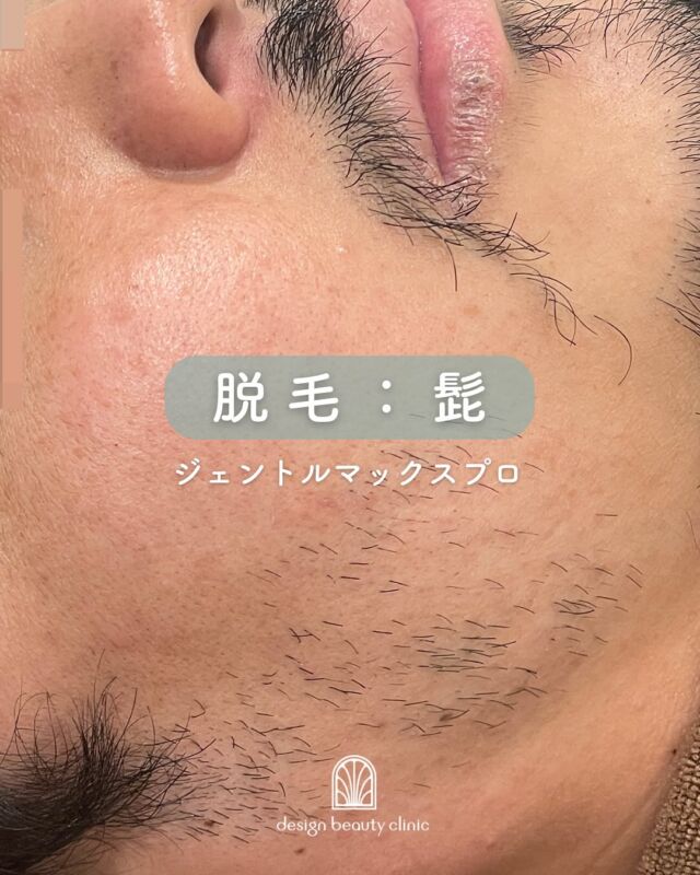 ✨

脱毛：顔・髭
毛穴の黒ずみや角質ケアに
イマイチ効果を感じられない
場合は、毛穴の汚れではなく
産毛が原因という可能性が高いです。
毛穴の汚れが溜まってしまうことで
黒ずみは悪化するものですが、
脱毛をすることによって毛穴が
引き締まり、汚れが溜まり
にくくなるので、黒ずみの改善にも
繋がります。
また、当院で取り扱っている
ジェントルマックスプロは、
レーザーフェイシャルの機能も
備えた脱毛機になりますので、
継続することにより肌のトーンアップや、
化粧ノリが良くなるといった
美肌効果も期待できます。

施術中のお痛みなどはほとんど
ございませんが、箇所や毛髪の
太さ濃さによって体感は異なります。
こちらの男性も髭脱毛のお痛みを
おさえるため、レベルを少し下げて
施術されておりますので、
ストレスなく受けていただいて
おります♪

メリットがたくさんある
医療レーザー脱毛も、夏の脱毛には
いくつか注意点があります！
・夏場は紫外線が強くなる為、
特に日焼け対策が必須になる。
・日焼けによってダメージを受けて
いる肌にレーザーを照射すると、
肌の赤みや腫れが強く出る可能性が
ある。
・火傷のリスクがあるため、日焼けの
程度では施術が出来ない可能性が
あるため、日頃から日焼け対策を
心掛けていく必要がある。

治療効果や回数、施術の反応等は
個人差がありますので、ご不明点が
ございましたらお問い合わせ下さい。

～脱毛がおすすめの方～
・自己処理後の毛穴のポツポツが気になる方
・自己処理が面倒な方
・脱毛と同時に美肌を目指したい方

☆女性 全顔初回：12,000円
☆女性 全顔通常：16,500円
☆男性 全顔初回：15,800円
☆男性 全顔通常：19,800円
・カウンセリング＋施術時間：施術部位によって異なります
・施術中の痛み：個人差がありますが、我慢できる程度です（必要時表面麻酔使用可能）
・ダウンタイム：２～３日程度、赤みやひりつき、点状出血等が生じる場合あり
・施術後のメイク：当日からOK

⚠️DMでのお問い合わせはお受けしておりません
お問い合わせは、クリニックへ直接お電話をお願いいたします🌱

————————————

ACCESS：大阪府大阪市北区茶屋町15-8
茶屋町ビル2階
TEL：06-6743-4652
営業時間：10時〜17時
(最終受付時間：16時)
お問合せ受付時間：10時〜19時

#美容皮膚科 #美容外科 #美容クリニック #脱毛 #髭脱毛 #美肌