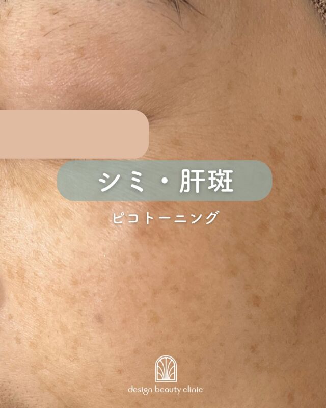 ✨
肝斑がある方はピコトーニングがおすすめです😊

ピコトーニング1回施術した症例です✨
施術後は少し赤みがでてますが、
時間と共にひいていきます❤️

ピコトーニングはダウンタイムもなく
予定の調整などがほとんど必要ないので
気軽に継続していただけます🫶

ピコトーニングは、1回で劇的な変化を得るのは
難しいですが、回数を重ねることで
「続けてよかった！」とおっしゃっていただける
ような結果が期待できます🙆‍♀️
継続は力なり✨結果は裏切りません♡

☆初回価格：9,800円
☆通常価格：15,800円

・カウンセリング+施術時間：約1時間
・施術中の痛み：ゴムで弾かれたような体感
（※個人差あり。）
・ダウンタイム：ほぼ無し
（※個人差あり。稀に膨隆疹、赤み、乾燥）
・施術後のメイク：即可能
・効果：肝斑改善、しみ、くすみ、
肌のハリ改善、毛穴の開き改善

————————————

ACCESS：大阪府大阪市北区茶屋町15-8
茶屋町ビル2階
TEL：06-6743-4652
営業時間：10時〜17時
(最終受付時間：16時)
お問合せ受付時間：10時〜19時

⚠️DMでのお問い合わせはお受けしておりません
お問い合わせは、クリニックへ直接お電話をお願いいたします🌱

#美容皮膚科 #美容外科 #美容クリニック #美肌 #女医 #美白 #アンチエイジング #シミ取り #レーザートーニング #肌質改善 #しみ #ハイフ #ウルトラセルQプラス #ルメッカ #フォトフェイシャル