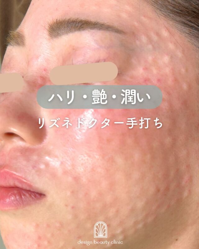 🤍
【リズネ（ドクター手打ち）症例紹介】📸
施術直後～8日後の様子です！
（1枚目のお写真は施術直後のお肌です）

赤みや軽い凹凸がますが、3日～1週間程度で落ち着いていきます🍀

また、施術後の鎮静ケアとしてエレクトロポレーションを併用することで、
赤みや刺激感の軽減にもつながります✨
痛みが気になる方やダウンタイムを少しでも抑えたい方にはとてもおすすめです🫧

✔ 肌の内側からふっくらとしたハリ感を実感
✔ 自然な仕上がりで美肌に✨
✔ 肌状態に合わせた丁寧な注入が可能💉

～リズネって何？～
リズネは、損傷した肌細胞の再生を促し、ハリ・ツヤ・うるおいを高める“肌育注射”です。
リジュランの後発品として、コストを抑えながらも同等の効果が期待できます✨
『ドクター手打ち』と『ハイコックス（水光注射機器）』、2種類の方法から選択可能です💆‍♀️

～リズネがおすすめな方～
・毛穴の開きや小じわが気になる
・肌のハリや弾力が低下してきた
・凹凸やちりめんじわを改善したい
・お肌の内側からの再生を目指したい

～リズネ・ドクター手打ちのメリット～
・細かい調整ができ、肌状態に合わせた施術が可能
・骨格や表情に合わせた自然な仕上がり
・小じわ・ハリ、ツヤ不足など、部位別に最適アプローチ

【リズネ】
リズネは
『ドクター手打ち』と『ハイコックス（水光注射機器）』の
2種類の打ち方からお選びいただけます❣️

■ドクター手打ち（全顔2cc）
通常：57,000円

■ハイコックス（水光注射機器）（全顔2cc）
初回：32,000円
通常：41,000円
3回コース：96,000円

・カウンセリング＋施術時間：約1時間
・施術中の痛み：チクっとした痛み、熱感あり（※表面麻酔使用）
・ダウンタイム：赤み、凹凸感、内出血が2～7日程度出る場合あり

■リズネについて
承認状況：国内未承認
入手経路：ARM社より入手
国内の承認医薬品などの有無：同一の成分や性能を有する他の国内承認医薬品等はありません
諸外国における安全性等に係る情報：韓国の食品医薬品安全庁（KFDA）の承認びCE認証

⚠️DMでのお問い合わせはお受けしておりません。
お問い合わせは、クリニックへ直接お電話をお願いいたします🌱

————————————

ACCESS：大阪府大阪市北区茶屋町15-8
茶屋町ビル2階
TEL：06-6743-4652
営業時間：10時〜17時（最終受付16時）
お問合せ受付時間：10時〜19時

#リズネ #肌育注射 #水光注射 #ドクター手打ち #スキンブースター #ハリ肌 #ツヤ肌 #毛穴改善 #リジュラン #韓国美容 #美容皮膚科 #デザインビューティークリニック