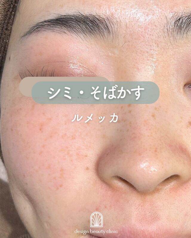 🌼
シミ・そばかすにアプローチ✨
ルメッカを1回受けた後、1ヶ月後までのご様子です
施術後に一時的にシミが濃くなるのは反応している証拠👀
徐々に薄くなっていく効果を感じられます💘

✔ シミ・そばかすを改善
✔ 肌のハリ・潤いアップ
✔ トーンアップ効果も✨

～ルメッカって何？～
ルメッカは、従来型IPLに比べて高出力・高効率で
シミやそばかすなどの肌トラブルに効果を発揮する光治療です。
コラーゲンやエラスチンの再生も促進されるため、
若々しいハリのある肌へ導きます✨

少ない回数で効果を実感しやすく、
シミが濃く反応した部分はターンオーバーにより10日前後で自然に薄くなります。
施術後はお肌の透明感がぐっとアップ！満足感の高い治療です♪

～ルメッカがおすすめな方～
・シミ・そばかすが気になる
・痛くない美肌治療がしたい
・肌のトーンアップを目指したい
・肌全体のハリ・潤いを取り戻したい

【料金案内】
☆全顔初回：12,800円
☆全顔通常：20,000円
☆手の甲初回：12,800円
☆手の甲通常：20,000円

・カウンセリング＋施術時間：約1時間
・施術中の痛み：個人差はありますが、我慢できる程度です
・ダウンタイム：2～3日～1週間程度、赤みやひりつきが生じる場合あり（個人差あり）
・施術後のメイク：当日からOK
・効果：シミ・そばかす・赤ら顔の改善、肌のハリ・潤いアップ

シミが出来る原因としては様々な要因が考えられるため、
治療後もシミが増えない肌作りをしていくために、
日頃の生活習慣の改善やスキンケアの見直しは必須となります。
インナーケアの手助けになるサプリメント、スキンケアも数多く
取り扱っておりますので、お気軽にご相談ください。

⚠️DMでのお問い合わせはお受けしておりません。
お問い合わせは、クリニックへ直接お電話をお願いいたします🌱

————————————

ACCESS：大阪府大阪市北区茶屋町15-8
茶屋町ビル2階
TEL：06-6743-4652
営業時間：10時〜17時（最終受付16時）
お

#ルメッカ #IPL治療 #シミ取り #そばかす改善 #赤ら顔治療 #トーンアップ #肌質改善 #美容皮膚科 #デザインビューティークリニック