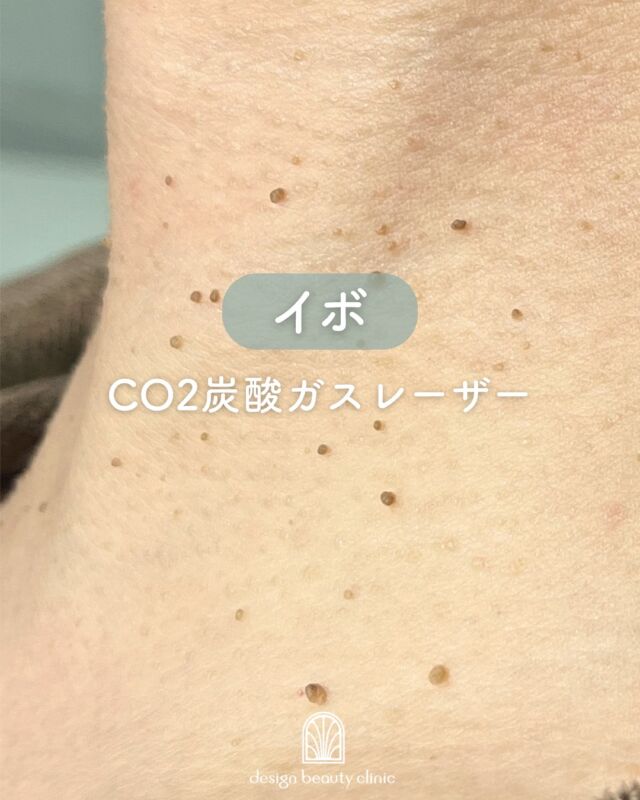 🌼
【イボ取り治療症例紹介】📸

気になる首イボをCO2レーザーで除去✨
施術前▶️施術直後▶️4ヶ月後の経過をご紹介します！

施術直後は赤みが目立つこともありますが、約3日〜1週間で落ち着き、
4ヶ月後には「最初から何もなかったみたいに！」とご実感いただきました🌿

✔ イボをピンポイントで除去
✔ 徐々に赤みが引いて自然な肌に
✔ 見た目の印象がすっきり明るく✨

～CO2炭酸ガスレーザーって何？～
CO2レーザーは、水分に反応する特性を活かし、
イボやほくろの除去に適したレーザー治療です。
照射部分の細胞内水分を瞬間的に蒸散させて皮膚を削り、
熱凝固作用で出血を最小限に抑えます。
皮膚表面だけに作用するため、治癒も比較的早く、傷跡も目立ちにくいのが特徴です✨

～こんな方におすすめ～
・首や顔のイボが気になる
・見た目の印象をすっきりさせたい
・再発を防ぎつつきれいに取りたい
・痛みや出血を最小限に抑えたい

【料金案内】
☆1～5個：5,500円／個
☆6～10個：11,000円／個
☆軟膏1本：700円
※別途麻酔代：3,000円

・カウンセリング＋施術時間：約1時間
・施術中の痛み：表面麻酔使用のため、痛みはほとんどありません（個人差あり）
・ダウンタイム：2週間程度、軟膏の塗布が必要
・施術後のメイク：患部を避ければ当日からOK

⚠️DMでのお問い合わせはお受けしておりません。
お問い合わせは、クリニックへ直接お電話をお願いいたします🌱

————————————

ACCESS：大阪府大阪市北区茶屋町15-8
茶屋町ビル2階
TEL：06-6743-4652
営業時間：10時〜17時（最終受付16時）
お問合せ受付時間：10時〜19時

#イボ取り #ほくろ除去 #CO2レーザー #炭酸ガスレーザー #イボ除去 #首イボ #肌トラブル改善 #美容皮膚科 #デザインビューティークリニック