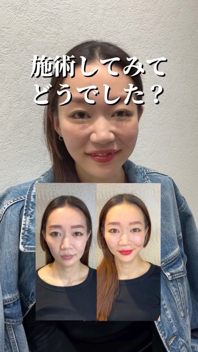 💋
【「ほんとに私の唇？」リップアートメイク💋】

「昔から唇に色がなくて、体調悪く見られるのが悩みで…」
そんな思いからリップアートメイクにチャレンジ✨

くすみを整えて血色感を引き出すベース作りの1回目✨
ナチュラルな色味で、すっぴんでも浮かないやさしい仕上がりに💄

今回は施術直後の感想をインタビュー🎤

少しの色味で、表情の印象はぐっと変わります🫧
リップに悩みがある方も、ぜひご来院ください🌿

.

➤施術名：アートメイクリップ　1回44,000円（税込）
➤施術の説明：皮膚の浅い層を専用針で傷をつけて色素を入れることにより、皮膚を着色する施術です。
➤リスク・副作用：炎症症状(発赤・腫脹・熱感・疼痛)、内出血、痒み、アレルギー反応、感染等。

⚠️DMでのお問い合わせはお受けしておりません
お問い合わせは、クリニックへ直接お電話をお願いいたします🌱

････････････････････････････････････････

■医療機関名
デザイン ビューティー クリニック

■ご予約方法
•WEB／LINE（プロフィールからリンクできます）
•電話

■電話番号（問い合わせ・予約）
メニューによって電話番号が異なります。

🌿アートメイク
　06-6616-8095

🌿美容皮膚科メニュー
　06-6743-4652

■店舗紹介
アートメイクは下記の3院どこでもお受けいただけます。

🏥梅田本院
〒530-0013 大阪府大阪市北区茶屋町15-8
茶屋町ビル2階

営業時間：10:00～19:00
定休日：不定休
診療メニュー：美容皮膚科 / アートメイク

🏥アートメイク梅田院
〒530-0014 大阪府大阪市北区鶴野町2-1
梅田タナダビル１階

営業時間：10:00～19:00
定休日：不定休
診療メニュー： アートメイク

🏥アートメイク心斎橋院
〒542-0083 大阪市中央区東心斎橋1-20-14
心斎橋エルナ岩崎ビル5階

営業時間：10:00～19:00
定休日：不定休
診療メニュー： アートメイク

････････････････････････････････････････

#アートメイク #美容クリニック #アートメイク眉 #アートメイクリップ #眉アート #アートメイク大阪 #アートメイク梅田 #大阪 #梅田 #茶屋町 #心斎橋 #難波
