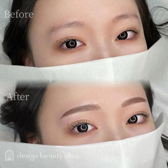 🪄
■お悩み・ご希望：
眉メイクが苦手で...とお悩みの患者さま💐
似合う眉にしてほしいとのことで
骨格に合ったデザインでメイク時短の眉を叶えました🫧✨
■施術内容：
パウダー+毛並み(4D)

お写真ご協力ありがとうございました☺️

➤施術名：アートメイク眉毛　1回33,000円（税込）
➤施術の説明：皮膚の浅い層を専用針で傷をつけて色素を入れることにより、皮膚を着色する施術です。
➤リスク・副作用：炎症症状(発赤・腫脹・熱感・疼痛)、内出血、痒み、アレルギー反応、感染等。

⚠️DMでのお問い合わせはお受けしておりません
お問い合わせは、クリニックへ直接お電話をお願いいたします🌱

････････････････････････････････････････

■医療機関名
デザイン ビューティー クリニック

■ご予約方法
•WEB／LINE（プロフィールからリンクできます）
•電話

■電話番号（問い合わせ・予約）
メニューによって電話番号が異なります。

🌿アートメイク
　06-6616-8095

🌿美容皮膚科メニュー
　06-6743-4652

■店舗紹介
アートメイクは下記の3院どこでもお受けいただけます。

🏥梅田本院
〒530-0013 大阪府大阪市北区茶屋町15-8
茶屋町ビル2階

営業時間：10:00～19:00
定休日：不定休
診療メニュー：美容皮膚科 / アートメイク

🏥アートメイク梅田院
〒530-0014 大阪府大阪市北区鶴野町2-1
梅田タナダビル１階

営業時間：10:00～19:00
定休日：不定休
診療メニュー： アートメイク

🏥アートメイク心斎橋院
〒542-0083 大阪市中央区東心斎橋1-20-14
心斎橋エルナ岩崎ビル5階

営業時間：10:00～19:00
定休日：不定休
診療メニュー： アートメイク

････････････････････････････････････････

#アートメイク #美容クリニック #アートメイク眉 #アートメイクリップ #眉アート #アートメイク大阪 #アートメイク梅田 #大阪 #梅田 #茶屋町 #心斎橋 #難波