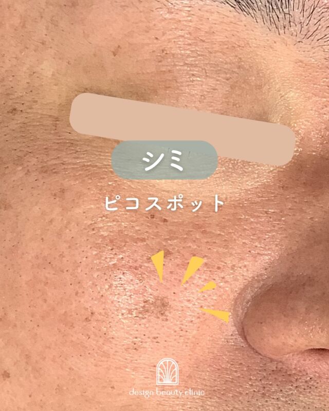 🌷
気になるシミをピンポイントで改善！✨

シミにお悩みの男性患者様、
施術前～1ヶ月後の症例です👩‍⚕️
頬のシミが綺麗になくなりました✨

ピコ秒単位の超短時間レーザーで、
メラニン色素をピンポイントに破壊👊✨
周囲の皮膚へのダメージを抑えつつ、しっかりシミを薄くしていきます💆‍♀️

✔ 少ないダウンタイム
✔ シミ・そばかすに対応
✔ 肌の透明感アップ✨

～ピコスポットって何？～
ピコ秒レーザーによるシミ取り治療です。
超短時間でメラニン色素を粉砕するため、従来のレーザーに比べて肌への負担が少なく、
治療後の赤みや色素沈着のリスクも軽減されています。

～ピコスポットがおすすめな方～
・特定のシミを取りたい
・早くきれいにしたい
・痛みやダウンタイムを最小限にしたい

【料金案内】
☆ピコスポット 1mm（最大10mmまで）1,100円
例：10mmの場合 11,000円
☆ピコスポット 3cm×5cm 通常：25,000円

・カウンセリング＋施術時間：範囲により異なります（約30分〜1時間目安）
・施術中の痛み：輪ゴムではじかれるような刺激（※表面麻酔希望の場合＋3,000円）
・ダウンタイム：1週間前後、かさぶた・赤みが出る場合あり
・施術後のメイク：当日からOK（施術部位を避けて）

⚠️DMでのお問い合わせはお受けしておりません。
お問い合わせは、クリニックへ直接お電話をお願いいたします🌱

————————————

ACCESS：大阪府大阪市北区茶屋町15-8
茶屋町ビル2階
TEL：06-6743-4652
営業時間：10時〜17時（最終受付16時）
お問合せ受付時間：10時〜19時

#ピコスポット #シミ #シミ取りレーザー #シミそばかす改善 #肌質改善 #ピコレーザー #美容皮膚科 #美容クリニック #デザインビューティークリニック