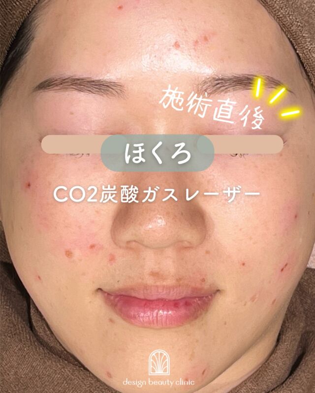 🌿
【ほくろ除去症例紹介】📸

目立つ場所にあるとコンプレックスになることもありますが、
当院ではCO2レーザーでピンポイントに除去が可能です💡
施術前▶️施術直後▶️3ヶ月後の様子をご紹介します！

✔ メイクでも隠しきれないホクロに
✔ 局所麻酔で痛みは最小限に
✔ 徐々に赤みが引いて自然な肌に整っていきます🌿

～CO2炭酸ガスレーザーって何？～
皮膚の水分に反応して瞬時に蒸散させることで、
皮膚表面のホクロを正確かつ出血少なく削ることができます。
照射後はテープ保護をしていただきながら、自然に再生する肌を待つだけでOK✨

ホクロの大きさやメラニンの深さによっては、1回の施術で取りきれないこともあります。
その場合、再施術は前回の施術から3ヶ月以上空ける必要があります📝

～こんな方におすすめ～
・目立つホクロを除去したい
・出血や痛みを抑えた治療がしたい
・顔や体の印象をスッキリさせたい
・繰り返すホクロへの不安を解消したい

【料金案内】
☆3mm以下：5,500円／個
☆8mm以下：11,000円／個
☆茶テープ1巻（保護用）：700円
☆軟膏1本：700円

・カウンセリング＋施術時間：約1時間
・施術中の痛み：局所麻酔時に軽度の痛みあり（個人差あり）
・ダウンタイム：2週間程度テープ保護が必要
・施術後のメイク：患部を避ければ当日からOK

⚠️DMでのお問い合わせはお受けしておりません。
お問い合わせは、クリニックへ直接お電話をお願いいたします🌱

————————————

ACCESS：大阪府大阪市北区茶屋町15-8
茶屋町ビル2階
TEL：06-6743-4652
営業時間：10時〜17時（最終受付16時）
お問合せ受付時間：10時〜19時

#ホクロ除去 #ほくろ取り #CO2レーザー #炭酸ガスレーザー #黒子 #肌印象改善 #美容皮膚科 #デザインビューティークリニック