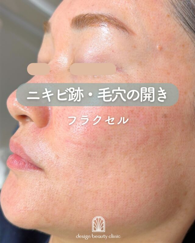 🤍
【フラクセル症例紹介】📸

施術前▶️施術直後▶️3日後▶️2週間後の様子をご紹介します🌷
（1枚目のお写真は施術3日後です）

肌の凹凸・毛穴・小じわ・ニキビ跡が気になる方に！
ダウンタイムがあっても本気で肌質を変えたい方におすすめのレーザー治療です💡

✔ 肌の再生力を高めてハリUP
✔ ニキビ跡・毛穴・小じわを集中ケア
✔ 本気で肌質改善をしたい方へ✨

～フラクセルって何？～
フラクセルは、肌表面に微細なレーザーを点状に照射し、
コラーゲンの生成やターンオーバーを促すフラクショナルレーザー治療です。

目に見えない極小の穴を一時的に肌にあけることで、自己修復力を活性化。
それにより肌のハリ・弾力UP、小じわの改善、毛穴の引き締め、ニキビ跡の浅化が期待できます。
赤みや皮むけなどのダウンタイムはありますが、しっかり変えたい方に選ばれています🔥

～こんな方におすすめ～
・ニキビ跡やクレーターが気になる
・毛穴の開きや凹凸を滑らかにしたい
・小じわ・キメの乱れが気になる
・肌質改善をしっかり行いたい

【料金案内】
☆全顔 初回：19,800円
☆全顔 通常：28,800円
☆部分(鼻または頬) 初回：9,900円
☆部分(鼻または頬) 通常：14,400円
※麻酔代別途：3,000円

・カウンセリング＋施術時間：約60分
・施術中の痛み：表面麻酔を使用（輪ゴムで弾かれるような刺激あり）
・ダウンタイム：赤み・皮むけ・乾燥・ざらつきが3日～1週間程度（個人差あり）

⚠️DMでのお問い合わせはお受けしておりません。
お問い合わせは、クリニックへ直接お電話をお願いいたします🌱

————————————

ACCESS：大阪府大阪市北区茶屋町15-8
茶屋町ビル2階
TEL：06-6743-4652
営業時間：10時〜17時（最終受付16時）
お問合せ受付時間：10時〜19時

#フラクセル #フラクセルレーザー #肌質改善 #ニキビ #ニキビ跡改善 #毛穴治療 #クレーター改善 #美容皮膚科 #デザインビューティークリニック