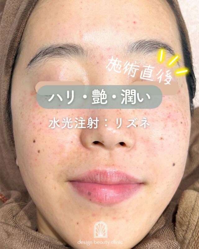 🤍
【リズネ症例紹介】📸

施術前▶️施術直後の様子です！
（1枚目のお写真は施術直後のお肌です）

ハイコックスは複数の極細針で注入するため、施術直後は点状の赤みが出ます。
「水玉模様」のような跡は、しっかりお肌にアプローチできた証しです✨

✔ 肌の内側からふっくらとしたハリ感を実感
✔ 自然な仕上がりで美肌に✨
✔ 肌状態に合わせた丁寧な注入が可能💉

～リズネって何？～
リズネは、損傷した肌細胞の再生を促し、ハリ・ツヤ・うるおいを高める“肌育注射”です。
リジュランの後発品として、コストを抑えながらも同等の効果が期待できます✨
『ドクター手打ち』と『ハイコックス（水光注射機器）』、2種類の方法から選択可能です💆‍♀️

～リズネがおすすめな方～
・毛穴の開きや小じわが気になる
・肌のハリや弾力が低下してきた
・凹凸やちりめんじわを改善したい
・お肌の内側からの再生を目指したい

～ハイコックス(水光注射機器)のメリット～
・均一かつスピーディーな薬剤注入が可能
・肌全体をムラなくアプローチ
・施術中の痛み・内出血が出にくく、ダウンタイムも少なめ

当院では韓国で人気の水光注射機器【ハイコックス】を使用✨
薬剤のロスが少なく、痛みも少ないので、初めての方にもおすすめです♪

【リズネ】
リズネは
『ドクター手打ち』と『ハイコックス（水光注射機器）』の
2種類の打ち方からお選びいただけます❣️

■ドクター手打ち（全顔2cc）
通常：57,000円

■ハイコックス（水光注射機器）（全顔2cc）
初回：32,000円
通常：41,000円
3回コース：96,000円

・カウンセリング＋施術時間：約1時間
・施術中の痛み：チクっとした痛み、熱感あり（※表面麻酔使用）
・ダウンタイム：赤み、凹凸感、内出血が2～7日程度出る場合あり

■リズネについて
承認状況：国内未承認
入手経路：ARM社より入手
国内の承認医薬品などの有無：同一の成分や性能を有する他の国内承認医薬品等はありません
諸外国における安全性等に係る情報：韓国の食品医薬品安全庁（KFDA）の承認びCE認証

⚠️DMでのお問い合わせはお受けしておりません。
お問い合わせは、クリニックへ直接お電話をお願いいたします🌱

————————————

ACCESS：大阪府大阪市北区茶屋町15-8
茶屋町ビル2階
TEL：06-6743-4652
営業時間：10時〜17時（最終受付16時）
お問合せ受付時間：10時〜19時

#リズネ #肌育注射 #水光注射 #スキンブースター #ハリ肌 #ツヤ肌 #毛穴改善 #リジュラン #韓国美容 #美容皮膚科 #デザインビューティークリニック
