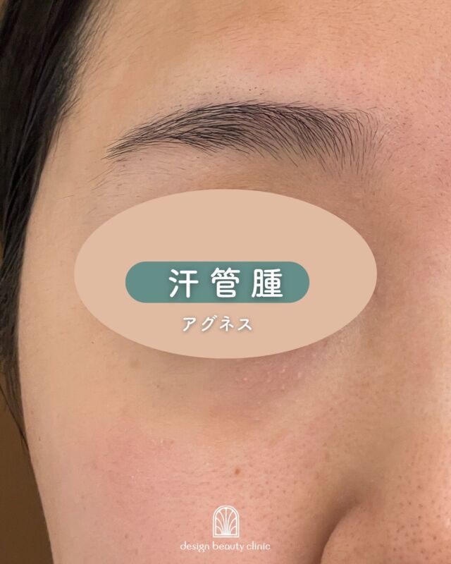 🌿
《汗管腫（かんかんしゅ）アグネス治療の3ヶ月後》
⁡
目のまわりのプツプツ、小さなふくらみ……それ、汗管腫かもしれません。
⁡
今回ご紹介するのは、アグネスによる治療から3ヶ月経過した患者様の症例です📷✨
⁡
💡アグネスとは？
高周波（RF）をピンポイントで照射することで、汗管腫の原因細胞にアプローチする治療です。ダウンタイムも少なく、少しずつ自然に目立たなくしていきます。
⁡
📸写真をご覧いただくと、
治療前と比べてプツプツ感が大きく改善されているのが分かります。
肌がなめらかになり、メイクのりも格段にアップ♪
⁡
「ずっと気になっていたけど、どうすればいいか分からなかった」
というお声を多くいただく症状のひとつです。
⁡
回数が必要になることが多いですが
回数を重ねていくことで効果を
ご実感頂ける施術でございます😊

気になる方は、ぜひお気軽にご相談ください☺️
無料カウンセリングも受付中です📩

☆初回 3×5㎝：21,600円
☆通常 3×5㎝：33,000円
・カウンセリング＋施術時間：約１時間
・施術中の痛み：表面麻酔使用
・ダウンタイム：１週間前後赤みや腫れ、熱感が生じる場合あり（個人差があります）
・施術後のメイク：術後３日以降～OK
・効果：汗管腫・ニキビ

～アグネスがおすすめの方～
・慢性的なニキビにお悩みの方
・ピーリング施術に効果を実感できなかった方
・処方薬を使用しても改善しなかった方
・レーザー施術で取り切れなかった汗管腫にお悩みの方

———————————

ACCESS：大阪府大阪市北区茶屋町15-8
茶屋町ビル2階
TEL：06-6743-4652
営業時間：10時〜17時
(最終受付時間：16時)
お問合せ受付時間：10時〜19時

⚠️DMでのお問い合わせはお受けしておりません
お問い合わせは、クリニックへ直接お電話をお願いいたします🌱

#美容皮膚科 #美容外科 #美容クリニック #汗菅腫 #アグネス #イボ#デザインビューティークリニック
