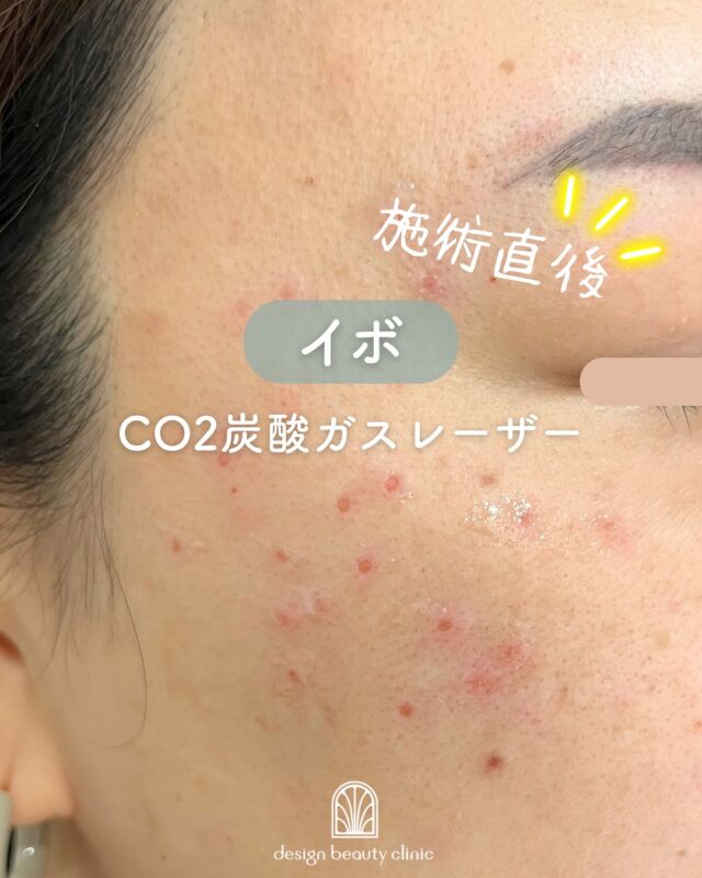 🌼
【イボ取り治療症例紹介】📸

気になる顔のイボをCO2レーザーで除去✨
施術前▶️施術直後の様子です😊

施術直後は赤みが目立つこともありますが、約3日〜1週間で落ち着きます🌿
治療後は一時的に傷になり、徐々にかさぶたへ。
かさぶたが自然に剥がれた後は、1〜3ヶ月ほどかけて新しい皮膚に再生していきます✨

✔ 目立っていたポツポツがすっきり
✔ 肌の質感がなめらかに
✔ 印象も明るく変化🌟

～CO2炭酸ガスレーザーって何？～
CO2レーザーは、水分に反応する特性を活かし、
イボやほくろの除去に適したレーザー治療です。
照射部分の細胞内水分を瞬間的に蒸散させて皮膚を削り、
熱凝固作用で出血を最小限に抑えます。
皮膚表面だけに作用するため、治癒も比較的早く、傷跡も目立ちにくいのが特徴です✨

～こんな方におすすめ～
・首や顔のイボが気になる
・見た目の印象をすっきりさせたい
・再発を防ぎつつきれいに取りたい
・痛みや出血を最小限に抑えたい

【料金案内】
☆1～5個：5,500円／個
☆6～10個：11,000円／個
☆軟膏1本：700円
※別途麻酔代：3,000円

・カウンセリング＋施術時間：約1時間
・施術中の痛み：表面麻酔使用のため、痛みはほとんどありません（個人差あり）
・ダウンタイム：2週間程度、軟膏の塗布が必要
・施術後のメイク：患部を避ければ当日からOK

⚠️DMでのお問い合わせはお受けしておりません。
お問い合わせは、クリニックへ直接お電話をお願いいたします🌱

————————————

ACCESS：大阪府大阪市北区茶屋町15-8
茶屋町ビル2階
TEL：06-6743-4652
営業時間：10時〜17時（最終受付16時）
お問合せ受付時間：10時〜19時

#イボ取り #ほくろ除去 #CO2レーザー #炭酸ガスレーザー #イボ除去 #肌トラブル改善 #美容皮膚科 #デザインビューティークリニック