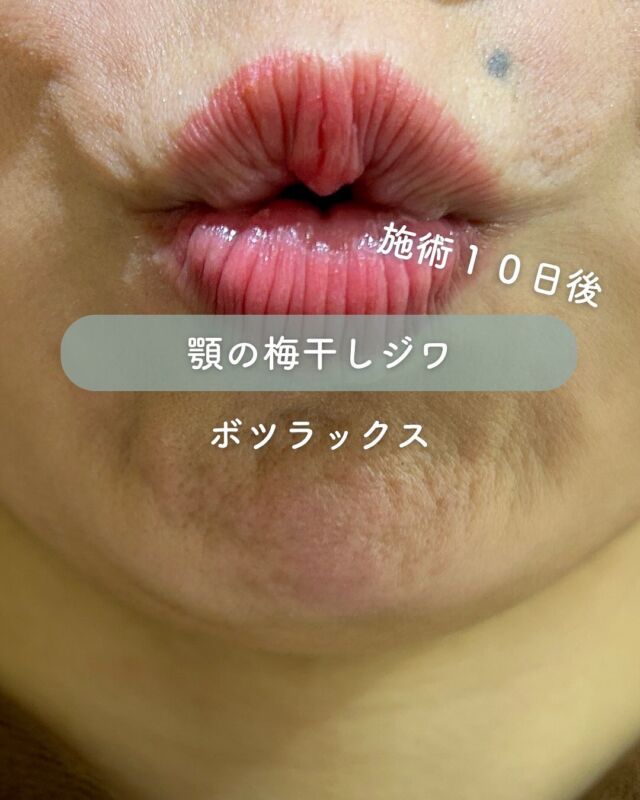 📸 
顎ボツラックス Before→After（10日後）
⁡
「梅干しジワ」と呼ばれる顎のシワが、10日でここまでスッキリ✨
ボツラックスでオトガイ筋（顎の筋肉）を優しくリラックスさせることで、自然な表情はそのままに、シワが目立たなくなりました！

💡 顎ボトックス（ボツラックス）のメリット
✔︎ 表情のクセによる顎のシワを改善
✔︎ 顎先の緊張が緩み、フェイスラインがなめらかに
✔︎ 食いしばり・顎の疲れの軽減にも効果的
✔︎ ダウンタイムがほぼなし、施術は数分で完了
✔︎ 初めてのボトックス施術としても人気◎

🪞 なぜ下顔面がスッキリ見えるの？
顎の筋肉が過剰に緊張していると、顎がギュッと縮こまって見えたり、輪郭がぼやけて見えることも。
ボツラックスで筋肉の緊張を和らげることで、顎先が自然とリラックスした位置に戻り、フェイスラインがすっきり整って見えるようになります✨

ナチュラルに美しい輪郭と表情を手に入れたい方、ぜひご相談ください😊

～ボツラックスって何？～
表情ジワは日常生活で表情筋を動かすことにより、お顔の筋肉が鍛えられ形成されてしまいます。
ボツラックス注射は、神経毒を筋肉に注入することで、
小顔やシワ改善などの美容効果が期待できる治療法です。
たとえば、顔のエラ部分に注射することで、エラの筋肉の
ボリュームが減り、フェイスラインをスッキリとさせることができます。
その他では汗を抑えたり、肩こり改善が期待できる治療方法です。

💉ボツラックスの効果持続期間
個人差はありますが3～4ヶ月程度とされています。
注射を行ってから2〜3日程度で効果があらわれはじめ、徐々にシワや多汗症などが改善されて、1ヶ月かけて身体に馴染んでいきます。

3〜4ヶ月をピークに徐々に効果が薄れていき、治療から6ヶ月経つ頃には効果もなくなっていることがほとんどです。
ボツラックス注射の効果を維持するために、4〜6ヶ月に一回定期的に施術を受けることがお勧めです。

💉ボツラックス注射がおすすめな方
・エラが気になる
・フェイスラインをスッキリさせたい
・顔の表情ジワが気になる
・マッサージを受けても肩こりが治らない
・首から肩の華奢なラインに憧れる
・ワキガや多汗症で悩んでいる

■額or眉間or目尻or目の下or顎
各：6,000円
・カウンセリング+施術時間：30分
・施術中の痛み：チクっとした痛みあり
（※個人差あり）
（※表面麻酔希望の場合：+3,000円）
・ダウンタイム：内出血がでる場合もありますが、徐々に落ち着きます。
ボツラックスは熱に弱い為、薬剤が安定するまでの１週間は血行を促進させるサウナや岩盤浴などは控えてください。
・施術後のメイク：施術部位を避ければ当日から可能
・効果：表情ジワの改善、エラの改善、小顔効果、肩こり改善、多汗症の改善

■ボツラックス
ボツラックス（Botulax）は、韓国のHugel社が製造したA型ボツリヌス毒素を有効成分とする薬剤です。
承認状況：国内未承認
入手経路：PRSS社より入手
国内の承認医薬品などの有無：同一の成分や性能を有する他の国内承認医薬品等はありません
諸外国における安全性等に係る情報：韓国の食品医薬品安全庁（KFDA）

⚠️DMでのお問い合わせはお受けしておりません
お問い合わせは、クリニックへ直接お電話をお願いいたします🌱

————————————

ACCESS：大阪府大阪市北区茶屋町15-8
茶屋町ビル2階
TEL：06-6743-4652
営業時間：10時〜17時
(最終受付時間：16時)
お問合せ受付時間：10時〜19時

#美容皮膚科 #美容外科 #美容クリニック #エイジング #アンチエイジング #シワ #ボツラックス #ボトックス#デザインビューティクリニック