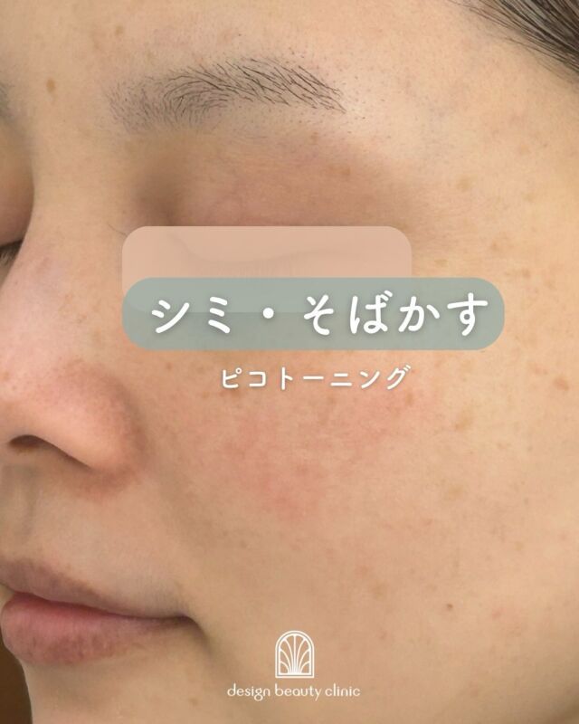 📸【ピコトーニング10回後の症例写真】
お顔全体のシミ・そばかすが目に見えて薄くなっているのがご覧いただけます✨

ピコトーニングは、肌に優しいレーザー治療で、シミ・そばかす・くすみの原因となるメラニンを少しずつ分解し、回数を重ねるごとに透明感のある明るい肌へ導きます。

☑ 痛みやダウンタイムが少ない
☑ 肌全体のトーンアップ
☑ 毛穴やハリ感にも嬉しい効果

ピコトーニングは、1回で劇的な変化を得るのは
難しいですが、回数を重ねることで
「続けてよかった！」とおっしゃっていただける
ような結果が期待できます🙆‍♀️
継続は力なり✨結果は裏切りません

当院では、お肌の状態やお悩みに合わせた最適な照射設定で施術を行っております。
気になる方はお気軽にカウンセリングへお越しください💬

☆初回価格：9,800円
☆通常価格：15,800円

・カウンセリング+施術時間：約1時間
・施術中の痛み：ゴムで弾かれたような体感
（※個人差あり。）
・ダウンタイム：ほぼ無し
（※個人差あり。稀に膨隆疹、赤み、乾燥）
・施術後のメイク：即可能
・効果：肝斑改善、しみ、くすみ、
肌のハリ改善、毛穴の開き改善

————————————

ACCESS：大阪府大阪市北区茶屋町15-8
茶屋町ビル2階
TEL：06-6743-4652
営業時間：10時〜17時
(最終受付時間：16時)
お問合せ受付時間：10時〜19時

⚠️DMでのお問い合わせはお受けしておりません
お問い合わせは、クリニックへ直接お電話をお願いいたします🌱

#美容皮膚科 #美容外科 #美容クリニック #美肌 #女医 #美白 #アンチエイジング #シミ取り #レーザートーニング #肌質改善 #しみ #ハイフ #ウルトラセルQプラス #ルメッカ #フォトフェイシャル
