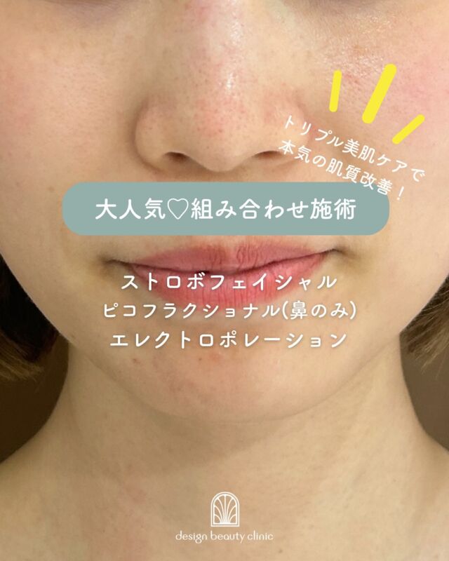 ✨
トリプル美肌ケアで本気の肌質改善！
ストロボフェイシャル × ピコフラクショナル × エレクトロポレーションの組み合わせ効果

毛穴・くすみ・ニキビ跡・乾燥・ハリ不足…
「肌悩みがひとつじゃない」あなたにこそおすすめしたい、
“表面〜深層まで”アプローチするトータル美肌プラン✨

🔹ストロボフェイシャル
（ハイドラジェントル＋マッサージピール）
古い角質や毛穴汚れをやさしく除去し、マッサージピールでツヤと透明感をアップ。
【土台づくり】として最適！

🔹ピコフラクショナル
ニキビ跡や毛穴の開き、小ジワにピンポイントでアプローチ。
肌の再生力を高めて、なめらかな質感に。

🔹エレクトロポレーション
美容成分をお肌の奥深くまでしっかり届け、うるおいとハリをプラス。
仕上げにぴったりな【保湿＆修復】ケア！

💎この3つを組み合わせると…
肌の表面のザラつき・毛穴汚れをオフ（ストロボフェイシャル）

肌の奥に刺激を与えて凹凸＆キメ改善（ピコフラクショナル）

最後に美容成分をたっぷり導入して保湿＆修復（エレクトロポレーション）

まさに「磨いて→整えて→満たす」トリプルステップで、
見た目も手触りも変わる“つるんとなめらかツヤ肌”へ導きます✨

◼️ストロボフェイシャル価格
初回 19,600円（税込）
通常 25,000円（税込）
【ハイドラジェントル】
・施術中の痛み：ひりつきを伴う場合あり
・ダウンタイム： 赤みや熱感、痒み等の肌荒れが生じる場合あり
・施術後のメイク：当日からOK
・効果：黒ずみ・ざらつきの改善、肌のトーンアップ、ハリ・艶感アップ

【コラーゲンピール】
・施術中の痛み：ほとんどなし
・ダウンタイム：赤みや乾燥、痒み等の肌荒れが生じる場合あり
・施術後のメイク：当日からOK
・効果：赤ら顔、ハリツヤ、目元の小じわ、肌質改善

◼️ピコフラクショナル価格
部分初回：7,900円
部分通常：12,750円
・カウンセリング＋施術時間：約１時間
・施術中の痛み：輪ゴムではじかれる感覚 、熱感あり
（※表面麻酔希望の場合：+ 3,000円）
・ダウンタイム：２～３日程度、
赤みやひりつき、点状出血等が生じる場合あり
・施術後のメイク：翌日からOK
・効果：毛穴の開き、ニキビ跡、ハリ、艶、小皺、肌質改善

◾️エレクトロポレーション
初回：5,500円
通常：6,600円
・カウンセリング＋施術時間：約60分
・施術中の痛み：電流によるピリピリ感があります。（個人差があります）
・ダウンタイム：なし
・施術後のメイク：当日からOK
・効果：美容成分導入・保湿・鎮静

★追加薬剤オプション
各3,300円
⭐︎美白（ビタミンC＋トラネキサム酸）
⭐︎ニキビ（ビタミンC＋ビタミンB）
⭐︎エイジング（ビタミンE＋EMN）

上記オプションに➕550円で、
さらにビタミンCの追加が可能❤️

※全て税込価格

ご質問などお気軽にお問い合わせ下さいませ♡

——————————

ACCESS：大阪府大阪市北区茶屋町15-8
茶屋町ビル2階
TEL：06-6743-4652
営業時間：10時〜17時
(最終受付時間：16時)
お問合せ受付時間：10時〜19時

#美容皮膚科 #美容外科 #美容クリニック #美肌 #女医 #美白 #アンチエイジング #肌質改善 #しみ #マッサージピール
#コラーゲンピール#デザインビューティークリニック#ピコフラクショナル#エレクトロポレーション