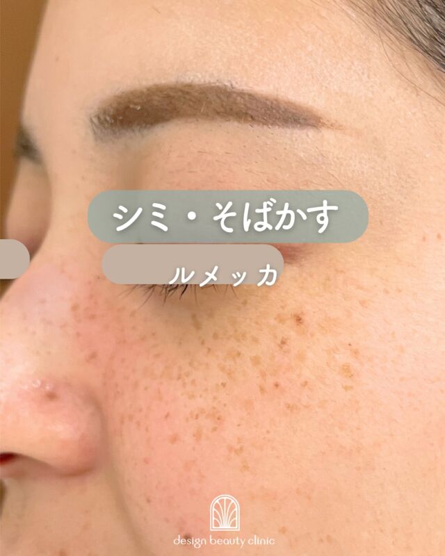 🤍
【ルメッカ症例紹介】📸

頬のシミにお悩みだった方の、施術前▶️1ヶ月後の経過をご紹介✨
シミがしっかり反応し、全体的に肌トーンも明るく変化しています！

✔ 濃いシミにしっかり反応
✔ 肌トーンが1トーン明るく
✔ ハリやツヤ感アップで若々しい印象に✨

～ルメッカって何？～
ルメッカは従来のIPLに比べて高出力・高反応の光治療。
シミ・そばかす・赤ら顔などの色ムラにアプローチしながら、
コラーゲン生成を促進し、肌のハリ・透明感も高めることができる美肌治療です🌿

治療直後は反応したシミが濃く浮き出ることもありますが、
約1週間程度で薄いかさぶたのように自然に剥がれ、1ヶ月かけてなめらかな肌に整っていきます。

～こんな方におすすめ～
・シミやそばかすが気になる
・肌のくすみ・色ムラを整えたい
・ダウンタイムが少ない治療を探している
・明るくツヤのある肌を目指したい

【料金案内】
☆全顔初回：12,800円
☆全顔通常：20,000円
☆手の甲初回：12,800円
☆手の甲通常：20,000円

・カウンセリング＋施術時間：約1時間
・施術中の痛み：個人差はありますが、我慢できる程度です
・ダウンタイム：2～3日～1週間程度、赤みやひりつきが生じる場合あり（個人差あり）
・施術後のメイク：当日からOK
・効果：シミ・そばかす・赤ら顔の改善、肌のハリ・潤いアップ

シミが出来る原因としては様々な要因が考えられるため、
治療後もシミが増えない肌作りをしていくために、
日頃の生活習慣の改善やスキンケアの見直しは必須となります。
インナーケアの手助けになるサプリメント、スキンケアも数多く
取り扱っておりますので、お気軽にご相談ください。

⚠️DMでのお問い合わせはお受けしておりません。
お問い合わせは、クリニックへ直接お電話をお願いいたします🌱

————————————

ACCESS：大阪府大阪市北区茶屋町15-8
茶屋町ビル2階
TEL：06-6743-4652
営業時間：10時〜17時（最終受付16時）
お問合せ受付時間：10時〜19時

#ルメッカ #IPL光治療 #シミ治療 #そばかす改善 #赤ら顔治療 #肌質改善 #美白ケア #トーンアップ #美容皮膚科 #デザインビューティークリニック