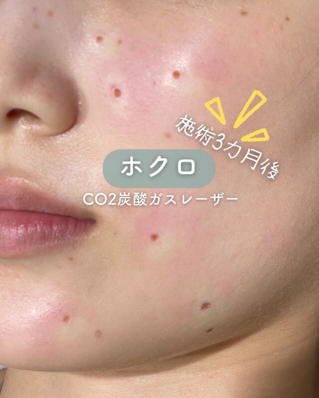 ✨
✨CO2炭酸ガスレーザーによるホクロ除去の症例紹介✨
⁡
こちらは、ホクロ除去から3か月後のお写真です📷
治療後は赤みやかさぶたが徐々に落ち着き、現在では傷跡もほとんど目立たず、
お肌全体が明るくなったように見える仕上がりになりました😊✨
⁡
CO2レーザーは、ホクロだけでなく小さなイボや脂漏性角化症などにも対応可能で、
お肌の印象をすっきりと整えるのにおすすめの治療です🌿
⁡
気になるホクロやお肌のお悩みがある方は、ぜひお気軽にご相談ください💁‍♀️

～CO2ﾚｰｻﾞｰってなに？～
もともと皮膚には水分が多く含まれており、CO2レーザーを照射することで細胞内の水分が
反応し、熱エネルギーを発生させます。
この熱エネルギーが水分を瞬間的に蒸散することで皮膚が削られ、ホクロが除去されます。
さらに、レーザーを照射した部位周辺の血管は熱凝固作用で瞬時に固まるため、出血の心配はほとんどありません。
また、CO2レーザーの蒸散作用は皮膚の表面のみで、深い層まで届かないので除去後の創傷治癒も比較的早いというのが特徴です。
CO2ﾚｰｻﾞｰの注意点として、ホクロの大きさやメラニンの深さによって1度の施術で取り切れない可能性あります。
その場合の再施術は、前回の施術から3カ月以上空ける必要有り、一時的に患部がへこんだり、傷跡が残る場合もあります。
しっかりとテープ保護を行ってください。

☆3㎜以下：5,500円 / 個
☆8㎜以下：11,000円 / 個
☆茶テープ1巻(保護用)：700円
☆軟膏1本：700円
・カウンセリング＋施術時間：約１時間
・施術中の痛み：局所麻酔の際に軽度の痛み有り
　（※個人差あり）
・ダウンタイム：２週間程度テープ保護必要
・施術後のメイク：患部を避けて当日からOK

⚠️DMでのお問い合わせはお受けしておりません
お問い合わせは、クリニックへ直接お電話をお願いいたします🌱

————————————

ACCESS：大阪府大阪市北区茶屋町15-8
茶屋町ビル2階
TEL：06-6743-4652
営業時間：10時〜17時
(最終受付時間：16時)
お問合せ受付時間：10時〜19時

#美容皮膚科 #美容外科 #美容クリニック #ほくろ取り #co2炭酸ガスレーザー #黒子 #ホクロ除去