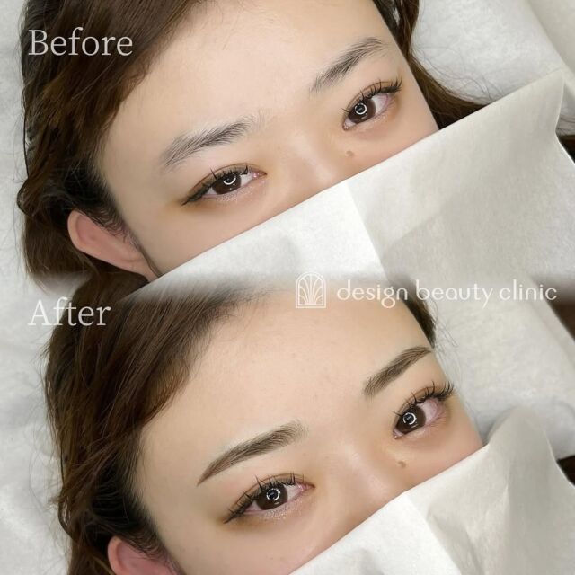 🪄
■お悩み・ご希望：
メイクを楽にしたい！とご来院いただきました🌼
角ばった眉山がお悩みとのことで、カーブ感のある柔らかなデザインで仕上げました🤍✨
■施術内容：
パウダー(2D)

お写真ご協力ありがとうございました☺️

➤施術名：アートメイク眉毛　1回33,000円（税込）
➤施術の説明：皮膚の浅い層を専用針で傷をつけて色素を入れることにより、皮膚を着色する施術です。
➤リスク・副作用：炎症症状(発赤・腫脹・熱感・疼痛)、内出血、痒み、アレルギー反応、感染等。

⚠️DMでのお問い合わせはお受けしておりません
お問い合わせは、クリニックへ直接お電話をお願いいたします🌱

････････････････････････････････････････

■医療機関名
デザイン ビューティー クリニック

■ご予約方法
•WEB／LINE（プロフィールからリンクできます）
•電話

■電話番号（問い合わせ・予約）
メニューによって電話番号が異なります。

🌿アートメイク
　06-6616-8095

🌿美容皮膚科メニュー
　06-6743-4652

■店舗紹介
アートメイクは下記の3院どこでもお受けいただけます。

🏥梅田本院
〒530-0013 大阪府大阪市北区茶屋町15-8
茶屋町ビル2階

営業時間：10:00～19:00
定休日：不定休
診療メニュー：美容皮膚科 / アートメイク

🏥アートメイク梅田院
〒530-0014 大阪府大阪市北区鶴野町2-1
梅田タナダビル１階

営業時間：10:00～19:00
定休日：不定休
診療メニュー： アートメイク

🏥アートメイク心斎橋院
〒542-0083 大阪市中央区東心斎橋1-20-14
心斎橋エルナ岩崎ビル5階

営業時間：10:00～19:00
定休日：不定休
診療メニュー： アートメイク

････････････････････････････････････････

#アートメイク #美容クリニック #アートメイク眉 #アートメイクリップ #眉アート #アートメイク大阪 #アートメイク梅田 #大阪 #梅田 #茶屋町 #心斎橋 #難波
