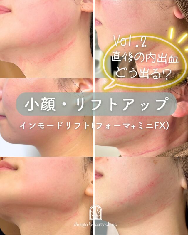 💛
【インモードリフト 内出血比較📸 第2弾】

施術直後のリアルな様子をご紹介！
今回は前回とはまた異なる複数の方の比較写真です✨

✔ 内出血がまったく出なかった方
✔ 少し赤みが残った方
✔ 内出血が広く出た方

実はこれ、すべて同じ施術内容でも体質や血管の出方で大きく個人差があるんです🌀
でもご安心ください。
しっかり内出血が出た方も、ほとんどが3〜5日程度で落ち着き、1週間ほどで目立たなくなります🌿
前回の投稿では翌日〜2日目〜1週間後の様子も掲載しておりますので合わせてチェックしてみてください🌷

繰り返しの治療で
「フェイスラインがより引き締まってきた！」
「肌のもたつきが改善された！」
など、嬉しいお声も続々✨

～インモードリフトって何？～
「フォーマ」で肌をじんわり温めて引き締め、
「ミニFX」で脂肪細胞にアプローチする2つの機能を組み合わせた最新小顔治療💆‍♀️
タイトニングと脂肪溶解、両方の効果が期待できます！

～こんな方におすすめ～
・フェイスラインのもたつきが気になる
・ダウンタイムは少なめがいい
・内出血が心配だけど効果はしっかりほしい
・切らずにリフトアップしたい

【料金案内】
☆インモードリフト（フォーマ＋ミニFXセット）初回：25,000円
☆通常：38,000円
☆3回コース：75,000円

☆フォーマ（両頬）初回：12,800円／通常：20,000円／3回：38,400円
☆ミニFX（両頬下またはアゴ下）初回：12,800円／通常：20,000円／3回：38,400円

・カウンセリング＋施術時間：メニューにより異なります
・施術中の痛み：個人差がありますが、痛みはほとんどなく、熱をじんわり感じる程度
・ダウンタイム：数日から1週間程度、赤み・腫れ・内出血が出る場合あり
・施術後のメイク：当日からOK
・リスク、副作用：内出血・腫れ・熱感・吸引性皮下出血・熱傷など（個人差あり）

⚠️DMでのお問い合わせはお受けしておりません。
お問い合わせは、クリニックへ直接お電話をお願いいたします🌱

————————————

ACCESS：大阪府大阪市北区茶屋町15-8
茶屋町ビル2階
TEL：06-6743-4652
営業時間：10時〜17時（最終受付16時）
お問合せ受付時間：10時〜19時

#インモードリフト #フォーマ #ミニFX #リフトアップ #たるみケア #小顔ケア #韓国 #美容皮膚科 #デザインビューティークリニック