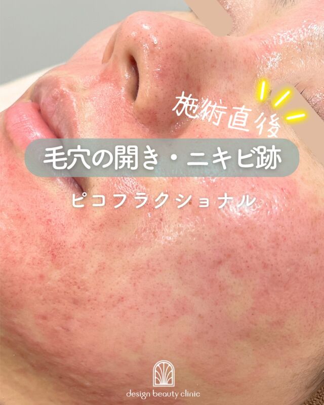 🌿
【ピコフラクショナル症例紹介】📸

毛穴の開き・ニキビ跡・小じわが気になる方に！
肌の変化をしっかり感じたい方におすすめの美肌治療✨

施術前▶️施術直後▶️エレクトロポレーション後の比較をご紹介✨
（1枚目のお写真は施術直後です）

✔ 肌の再生力を高めてなめらかに
✔ 毛穴・ニキビ跡・小じわを集中ケア
✔ ハリ・ツヤ感アップで明るい肌印象へ

施術直後は赤みや熱感が出やすい施術ですが、
エレクトロポレーションを組み合わせることで鎮静＋美容成分導入が可能に。
翌日からの肌の回復スピードがぐっと高まります🍃

～ピコフラクショナルって何？～
ピコ秒（1兆分の1秒）の超短時間照射による微細レーザーを点状に肌に照射し、
自然治癒力を活性化。
従来のフラクショナルレーザーに比べて肌ダメージが少なく、
赤みや痛みの軽減が期待できます。
コラーゲン生成を促進し、毛穴の開き・ニキビ跡・小じわ・ざらつきなどを改善します✨

～こんな方におすすめ～
・ニキビ跡や毛穴の凹凸が気になる
・小じわ・肌のざらつきが気になる
・フラクセルよりダウンタイムを抑えたい
・肌のハリや艶感をアップさせたい

【料金案内】
☆全顔 初回：15,800円
☆全顔 通常：25,500円
※表面麻酔代別途：3,000円

・カウンセリング＋施術時間：約60分
・施術中の痛み：輪ゴムではじかれるような刺激、熱感あり（個人差あり）
・ダウンタイム：2～3日程度、赤み・ひりつき・点状出血が出る場合あり
・施術後のメイク：翌日からOK

⚠️DMでのお問い合わせはお受けしておりません。
お問い合わせは、クリニックへ直接お電話をお願いいたします🌱

————————————

ACCESS：大阪府大阪市北区茶屋町15-8
茶屋町ビル2階
TEL：06-6743-4652
営業時間：10時〜17時（最終受付16時）
お問合せ受付時間：10時〜19時

#ピコフラクショナル #毛穴治療 #ニキビ跡改善 #フラクショナルレーザー #肌質改善 #ハリツヤ肌 #再生レーザー #美容皮膚科 #デザインビューティークリニック