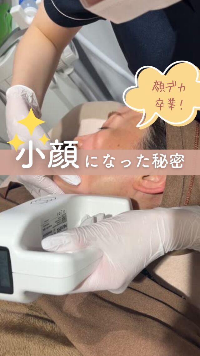 😃
顔まわり、こんなに変わるなんて…！

インモードでたるみ、脂肪をしっかり引き締めて、
2週間後にエラのボツラックスで仕上げました💉✨

輪郭がすっきりすると、
全体の印象もガラッと変わります。
「なんか痩せた？」って言われる嬉しさ…☺️

✔ 小顔になりたい
✔ 顔の下半分が重く見える
✔ 自然に印象を変えたい
そんな方におすすめです💡

インモードとボツラックスは
同日には出来ないため
施術の順番や間隔も含めて、
丁寧にご提案します🪞
お気軽に無料カウンセリングへ🌿

～インモードリフトって何？～
「フォーマ」で肌をじんわり温めて引き締め、
「ミニFX」で脂肪細胞にアプローチする2つの機能を組み合わせた最新小顔治療💆‍♀️
タイトニングと脂肪溶解、両方の効果が期待できます！

～こんな方におすすめ～
・フェイスラインのもたつきが気になる
・ダウンタイムは少なめがいい
・内出血が心配だけど効果はしっかりほしい
・切らずにリフトアップしたい

【料金案内】
☆インモードリフト（フォーマ＋ミニFXセット）初回：25,000円
☆通常：38,000円
☆3回コース：75,000円

☆フォーマ（両頬）
初回：12,800円
通常：20,000円
3回：38,400円

☆ミニFX（両頬下またはアゴ下）
初回：12,800円
通常：20,000円
3回：38,400円

・カウンセリング＋施術時間：メニューにより異なります
・施術中の痛み：個人差がありますが、痛みはほとんどなく、熱をじんわり感じる程度
・ダウンタイム：数日から1週間程度、赤み・腫れ・内出血が出る場合あり
・施術後のメイク：当日からOK
・リスク、副作用：内出血・腫れ・熱感・吸引性皮下出血・熱傷など（個人差あり）

～ボトックス注射がおすすめな方～
・エラが気になる
・フェイスラインをスッキリさせたい
・顔の表情ジワが気になる
・マッサージを受けても肩こりが治らない
・首から肩の華奢なラインに憧れる
・ワキガや多汗症で悩んでいる

【料金案内】
エラ
☆Single：10,000円
☆double：16,000円
☆triple：25,000円
・カウンセリング+施術時間：30分
・施術中の痛み：チクっとした痛みあり
（※個人差あり）
（※表面麻酔希望の場合：+3,000円）
・ダウンタイム：内出血がでる場合もありますが、徐々に落ち着きます。
ボトックスは熱に弱い為、薬剤が安定するまでの１週間は血行を促進させるサウナや岩盤浴などは控えてください。
・施術後のメイク：施術部位を避ければ当日から可能
・効果：表情ジワの改善、エラの改善、小顔効果、肩こり改善、多汗症の改善

■ボツラックス
ボツラックス（Botulax）は、韓国のHugel社が製造したA型ボツリヌス毒素を有効成分とする薬剤です。
承認状況：国内未承認
入手経路：PRSS社より入手
国内の承認医薬品などの有無：同一の成分や性能を有する他の国内承認医薬品等はありません
諸外国における安全性等に係る情報：韓国の食品医薬品安全庁（KFDA）

⚠️DMでのお問い合わせはお受けしておりません。
お問い合わせは、クリニックへ直接お電話をお願いいたします🌱

————————————

ACCESS：大阪府大阪市北区茶屋町15-8
茶屋町ビル2階
TEL：06-6743-4652
営業時間：10時〜17時（最終受付16時）
お問合せ受付時間：10時〜19時

#インモードリフト #フォーマ #ミニFX #リフトアップ #たるみケア #小顔ケア #韓国 #美容皮膚科 #デザインビューティークリニック