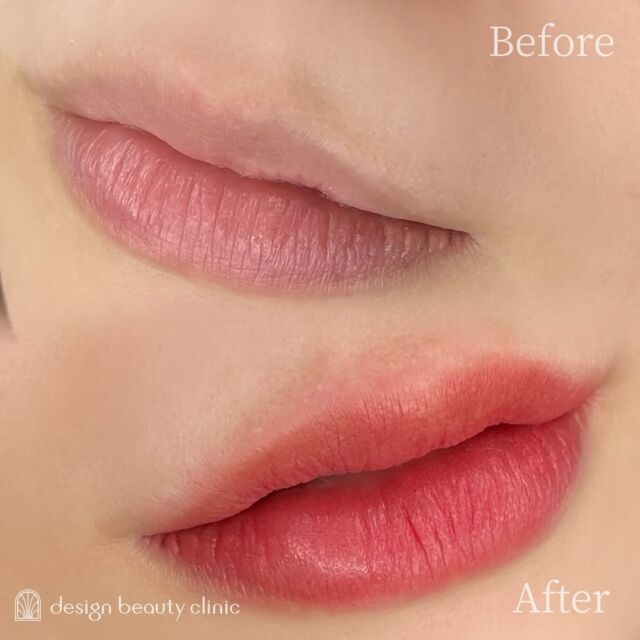💋
■お悩み・ご希望：
血色が悪く、顔色も悪く見えるのがお悩みとご来院くださいました✨
直後から可愛い色味♪
痛みもほとんど問題なく、施術中は寝ていましたとのことでした💤
■施術内容：
リップアートメイク

お写真ご協力ありがとうございました☺️

➤施術名：アートメイクリップ　1回44,000円（税込）
➤施術の説明：皮膚の浅い層を専用針で傷をつけて色素を入れることにより、皮膚を着色する施術です。
➤リスク・副作用：炎症症状(発赤・腫脹・熱感・疼痛)、内出血、痒み、アレルギー反応、感染等。

⚠️DMでのお問い合わせはお受けしておりません
お問い合わせは、クリニックへ直接お電話をお願いいたします🌱

････････････････････････････････････････

■医療機関名
デザイン ビューティー クリニック

■ご予約方法
•WEB／LINE（プロフィールからリンクできます）
•電話

■電話番号（問い合わせ・予約）
メニューによって電話番号が異なります。

🌿アートメイク
　06-6616-8095

🌿美容皮膚科メニュー
　06-6743-4652

■店舗紹介
アートメイクは下記の3院どこでもお受けいただけます。

🏥梅田本院
〒530-0013 大阪府大阪市北区茶屋町15-8
茶屋町ビル2階

営業時間：10:00～19:00
定休日：不定休
診療メニュー：美容皮膚科 / アートメイク

🏥アートメイク梅田院
〒530-0014 大阪府大阪市北区鶴野町2-1
梅田タナダビル１階

営業時間：10:00～19:00
定休日：不定休
診療メニュー： アートメイク

🏥アートメイク心斎橋院
〒542-0083 大阪市中央区東心斎橋1-20-14
心斎橋エルナ岩崎ビル5階

営業時間：10:00～19:00
定休日：不定休
診療メニュー： アートメイク

････････････････････････････････････････

#アートメイク #美容クリニック #アートメイク眉 #アートメイクリップ #眉アート #アートメイク大阪 #アートメイク梅田 #大阪 #梅田 #茶屋町 #心斎橋 #難波