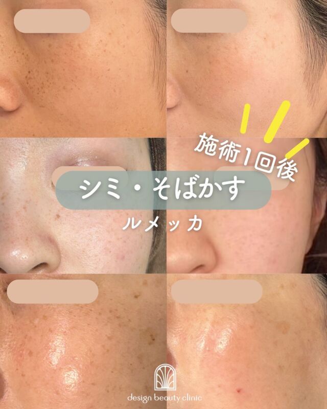 ✨
【ルメッカ1回施術《1か月後》の症例をご紹介】
当院で人気の光治療《ルメッカ》の症例を、3名分ご紹介いたします📸

今回は、1回の施術から1か月後に撮影した、しっかりと効果が現れた症例写真を掲載しています。

💠 3名の患者さまそれぞれ、こんなお悩みが改善されています：
📍濃いしみ・そばかすが目立たなくなった
📍肌全体のくすみが取れ、トーンが明るくなった
📍ファンデーションなしでも肌にツヤが出るように

一人ひとり異なる肌状態でしたが、共通して「1回でここまで変わるの⁉」と喜んでいただけました😊

🕊施術後は、肌の反応を見ながら少しずつ変化していき、約2週間～1か月後に最も効果が安定して見えると言われています。
今回の症例も、そのタイミングで撮影したものです。

📌治療効果の現れ方には個人差があります。
お肌の状態やしみの種類・深さなどにより、必要な回数やケア方法は異なります。
まずは丁寧なカウンセリングで、お悩みをしっかりお伺いさせていただきますのでご安心ください。

～ルメッカって何？～
ルメッカは従来のIPLに比べて高出力・高反応の光治療。
シミ・そばかす・赤ら顔などの色ムラにアプローチしながら、
コラーゲン生成を促進し、肌のハリ・透明感も高めることができる美肌治療です🌿

治療直後は反応したシミが濃く浮き出ることもありますが、
約1週間程度で薄いかさぶたのように自然に剥がれ、1ヶ月かけてなめらかな肌に整っていきます。

～こんな方におすすめ～
・シミやそばかすが気になる
・肌のくすみ・色ムラを整えたい
・ダウンタイムが少ない治療を探している
・明るくツヤのある肌を目指したい

【料金案内】
☆全顔初回：12,800円
☆全顔通常：20,000円
☆手の甲初回：12,800円
☆手の甲通常：20,000円

・カウンセリング＋施術時間：約1時間
・施術中の痛み：個人差はありますが、我慢できる程度です
・ダウンタイム：2～3日～1週間程度、赤みやひりつきが生じる場合あり（個人差あり）
・施術後のメイク：当日からOK
・効果：シミ・そばかす・赤ら顔の改善、肌のハリ・潤いアップ

シミが出来る原因としては様々な要因が考えられるため、
治療後もシミが増えない肌作りをしていくために、
日頃の生活習慣の改善やスキンケアの見直しは必須となります。
インナーケアの手助けになるサプリメント、スキンケアも数多く
取り扱っておりますので、お気軽にご相談ください。

⚠️DMでのお問い合わせはお受けしておりません。
お問い合わせは、クリニックへ直接お電話をお願いいたします🌱

————————————

ACCESS：大阪府大阪市北区茶屋町15-8
茶屋町ビル2階
TEL：06-6743-4652
営業時間：10時〜17時（最終受付16時）
お問合せ受付時間：10時〜19時

#ルメッカ #LUMECCA #光治療 #しみ治療 #シミ改善 #肌トーンアップ #フォトフェイシャル #美肌ケア #症例紹介#IPL光治療 #シミ治療 #そばかす改善 #赤ら顔治療 #肌質改善 #美白ケア #トーンアップ #美容皮膚科 #デザインビューティークリニック