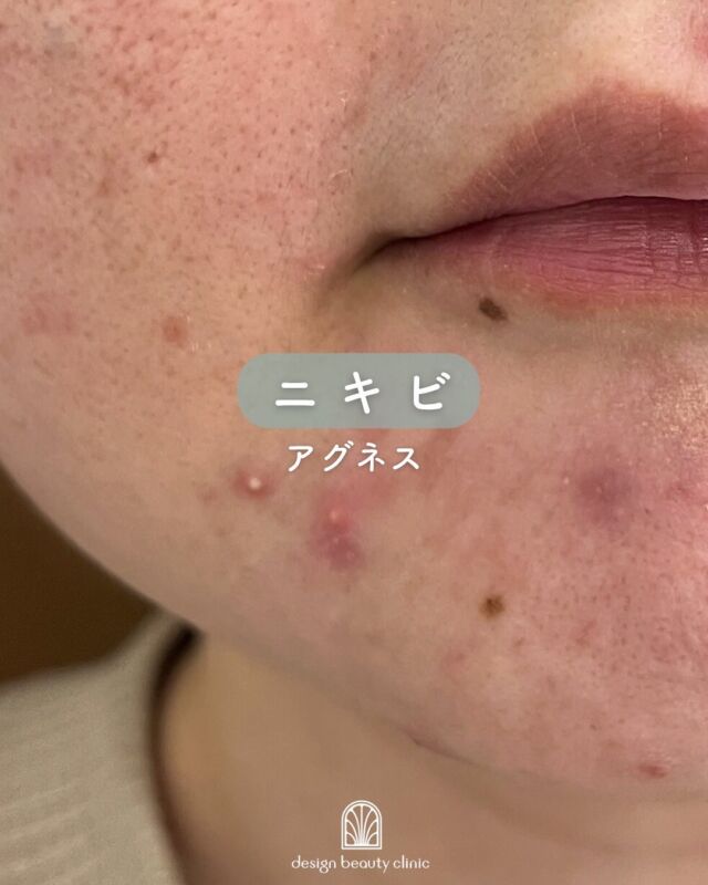 📷
【アグネスで顎ニキビ治療】
〜ダウンタイム経過をご紹介します〜

繰り返す顎ニキビにお悩みの患者さまに、皮脂腺に直接アプローチする「アグネス」治療を行いました。

今回は、施術後1か月間のダウンタイムの様子を写真とともにご紹介いたします📷

📍施術部位：顎
📍治療目的：炎症を繰り返すニキビの根本改善

🗓【施術直後】
照射部位に赤みが出ていますが、大きな腫れはなく、当日中に落ち着いていくことがほとんどです。
多少のチクチク感はありますが、日常生活に大きな支障はありません。

🗓【3日後】
治療で皮脂腺が熱で破壊されることで、内部にたまっていた皮脂が排出され、一時的にニキビが出ることがあります。
これは正常な反応であり、皮脂が表に出ることで肌の再生が始まっている証拠です。

🗓【1週間後】
赤みが引き、肌の表面は少しずつ落ち着いてきます。
この時期は保湿とUVケアをしっかり行っていただくことで、より早く安定します。

🗓【1か月後】
炎症を繰り返していたニキビが大きく改善し、赤みもおさまりました。
肌質の変化や、ニキビができにくくなったという実感をされる方が多い時期です。

～アグネスって何？～
アグネスは、選択的に皮脂腺を破壊することで、
ニキビの原因を根本から治療する本質的なニキビ治療治療です。
「毛根を破壊して脱毛ができる」のと同様に、
破壊された皮脂腺は再生せず、長期的なニキビ予防効果が期待できます💥

当院では施術前にしっかりとカウンセリングを行い、
生活習慣やスキンケアの見直しもサポート✨
肌に合った基礎化粧品やインナーケアもご提案しています♪

～アグネスがおすすめな方～
・繰り返す炎症性ニキビに悩んでいる
・口周りや顎にニキビができやすい
・他の治療で改善しなかった
・ニキビ痕や赤みが残っている

また、以下の治療と併用することで相乗効果が高まります👇
◇サリチル酸ピーリング（不要な角質ケア）
◇エレクトロポレーション（炎症抑制＆薬剤導入）
◇ジェネシス（ニキビ痕・赤みケア）

【料金案内】
☆全顔初回：39,800円
☆全顔通常：59,800円
☆部分初回：10,800円
☆部分通常：16,500円
※麻酔代別途：3,000円
※汗管腫の施術は上記とは異なる料金設定です

・カウンセリング＋施術時間：約1時間
・施術中の痛み：表面麻酔を使用します
・ダウンタイム：1週間前後、赤み・腫れ・熱感が生じる場合あり（個人差あり）
・施術後のメイク：術後3日以降から可能
・効果：ニキビ、汗管腫への改善

⚠️DMでのお問い合わせはお受けしておりません。
お問い合わせは、クリニックへ直接お電話をお願いいたします🌱

————————————

ACCESS：大阪府大阪市北区茶屋町15-8
茶屋町ビル2階
TEL：06-6743-4652
営業時間：10時〜17時（最終受付16時）
お問合せ受付時間：10時〜19時

#アグネス #ニキビ治療 #繰り返すニキビ #口周りニキビ #皮脂腺破壊 #汗管腫 #美容皮膚科 #ダウンタイム経過 #ニキビ跡予防 #ニキビ治療経過#デザインビューティークリニック