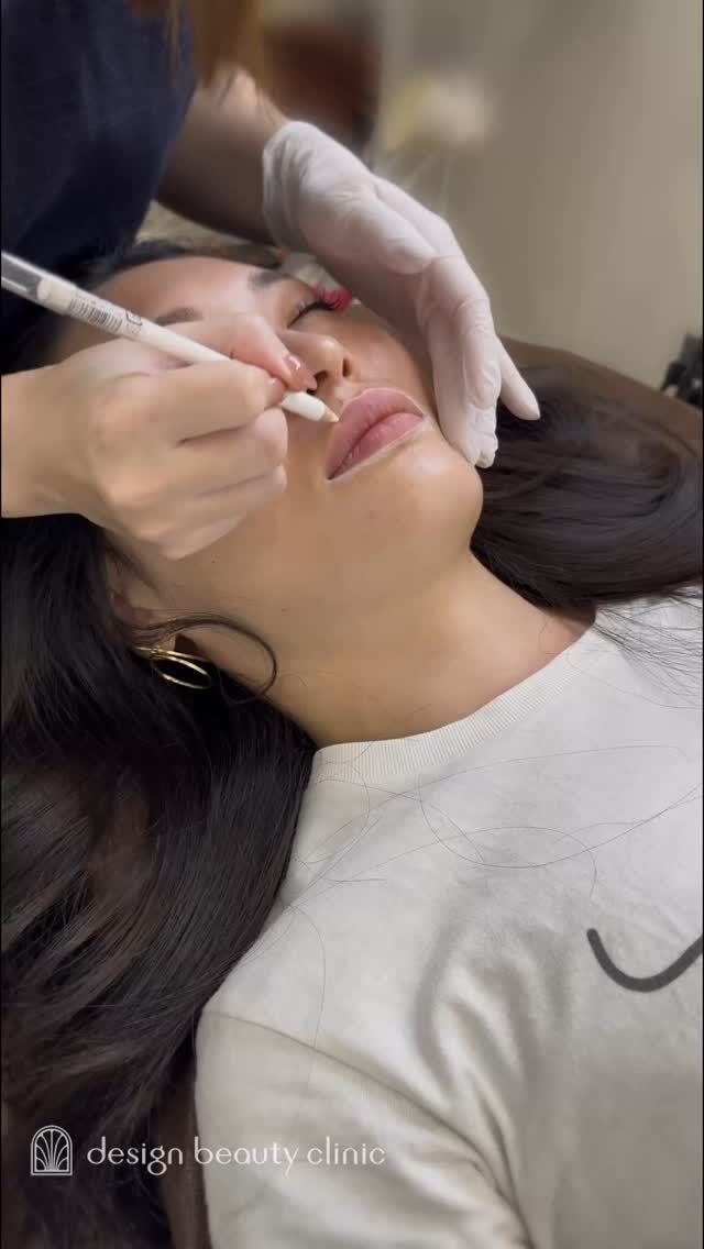 💋
【ティントで荒れがちな唇に、安定感のある色を💄】

「ティントで唇がすぐ荒れてしまうから、安定した色がほしい」
そんなお悩みから始まったリップアートメイク🪄

くすみが少ない唇の状態を活かしながら、
好みの色味に近づけながら血色感もプラスする仕上がりに✨

施術後には「めっちゃ好きな赤色です！」とのうれしいお声も💐

.

➤施術名：アートメイクリップ　1回44,000円（税込）
➤施術の説明：皮膚の浅い層を専用針で傷をつけて色素を入れることにより、皮膚を着色する施術です。
➤リスク・副作用：炎症症状(発赤・腫脹・熱感・疼痛)、内出血、痒み、アレルギー反応、感染等。

⚠️DMでのお問い合わせはお受けしておりません
お問い合わせは、クリニックへ直接お電話をお願いいたします🌱

････････････････････････････････････････

■医療機関名
デザイン ビューティー クリニック

■ご予約方法
•WEB／LINE（プロフィールからリンクできます）
•電話

■電話番号（問い合わせ・予約）
メニューによって電話番号が異なります。

🌿アートメイク
　06-6616-8095

🌿美容皮膚科メニュー
　06-6743-4652

■店舗紹介
アートメイクは下記の3院どこでもお受けいただけます。

🏥梅田本院
〒530-0013 大阪府大阪市北区茶屋町15-8
茶屋町ビル2階

営業時間：10:00～19:00
定休日：不定休
診療メニュー：美容皮膚科 / アートメイク

🏥アートメイク梅田院
〒530-0014 大阪府大阪市北区鶴野町2-1
梅田タナダビル１階

営業時間：10:00～19:00
定休日：不定休
診療メニュー： アートメイク

🏥アートメイク心斎橋院
〒542-0083 大阪市中央区東心斎橋1-20-14
心斎橋エルナ岩崎ビル5階

営業時間：10:00～19:00
定休日：不定休
診療メニュー： アートメイク

････････････････････････････････････････

#アートメイク #美容クリニック #アートメイク眉 #アートメイクリップ #眉アート #アートメイク大阪 #アートメイク梅田 #大阪 #梅田 #茶屋町 #心斎橋 #難波