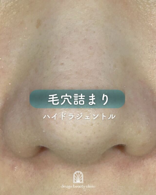 🫧
ハイドラジェントル
〜毛穴汚れがスッキリ✨ビフォーアフター〜

こちらは「施術前 → ポアレス後 → ハイドラジェントル施術後」のお写真です📸
毛穴に詰まった皮脂や角栓がしっかり取れ、お肌がなめらかに整っているのがよくわかる症例です✨

当院では、ハイドラジェントル前に「ポアレス」を行っています。
ポアレスを行うことで毛穴の汚れを浮かせ、吸引時の肌への負担を軽減🫧
より効果的でやさしい施術が可能になります。

💡当院ではこのポアレス、オプション料金なしでご提供しております😊
しっかりケアしたいけど肌へのやさしさも大事…という方にぴったりです。

毛穴の黒ずみや詰まりが気になる方は、ぜひ一度ご相談くださいね🫶

～ハイドラジェントルってなに？～
ハイドラジェントルとは、特殊な水流の力と２種類のピーリング剤を使用し、肌や毛穴の汚れを取るウォーターピーリングマシンです。
水溶性のピーリング剤(AHA)でお肌の汚れや古い角質を除去した後、油溶性のピーリング剤(BHA)で毛穴の黒ずみや角栓を除去していきます。
このピーリング剤をお肌に噴射させながら汚れを吸引していくので、お肌に負担をかけずに不要な角質や毛穴詰まりを取り除くことができます。
施術後はメイクもしていただけるので気軽に受けていただけます。
毛穴の詰まりや開き・黒ずみ・ニキビやオイリー肌など、
お肌に悩みをお持ちの方には是非一度受けていただきたいオススメの施術です♪

☆水溶性ピーリング剤（AHA)
乳酸やグリコール酸を主成分とした水溶性のピーリング剤で、角質に作用し毛穴の汚れや老廃物除去、角質を除去します。
AHAは柑橘類やリンゴなどに含まれる天然由来の成分です♪

☆油溶性ピーリング剤（BHA)
サリチル酸、ラクトビオン酸を主成分としたピーリング剤で、毛穴の奥深くまで行き届き、毛穴の黒ずみを除去します。
AHAは皮膚表面の角質に作用しますが、BHAは毛穴の皮脂を溶かし、毛穴の汚れや角栓を除去します♪

～ハイドラジェントルがお勧めの方～
・毛穴の黒ずみを改善したい方
・脂性肌や毛穴の開きを改善したい方
・肌のざらつきが気になる方
・肌に透明感を出したい方
・肌のくすみが気になる方
・ニキビにお悩みの方

★初回全顔：9,800円
★通常全顔：13,800円

・カウンセリング＋施術時間： 30分
・施術中の痛み：ひりつきを伴う場合あり
・ダウンタイム： 赤みや熱感、痒み等の肌荒れが生じる場合あり
・施術後のメイク：当日からOK
・効果：黒ずみ・ざらつきの改善、肌のトーンアップ、ハリ・艶感アップ

————————————

ACCESS：大阪府大阪市北区茶屋町15-8
茶屋町ビル2階
TEL：06-6743-4652
営業時間：10時〜17時
(最終受付時間：16時)
お問合せ受付時間：10時〜19時

#design beauty clinic #デザインビューティークリニック #美容皮膚科 #美容外科 #ハイドラジェントル #ハイドラジェントル効果 #美肌治療 #肌ケア #透明感アップ #美容外科 #エイジングケア #スキンケア #アンチエイジング #美肌革命