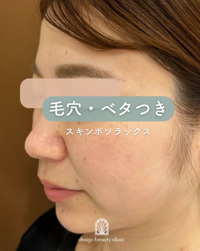 ✨
【スキンボトックス（ボツラックス）施術1か月後の症例】
お肌の変化、ぜひご覧ください💁‍♀️💕

施術から1か月が経過したお写真をご紹介します📸
毛穴がキュッと引き締まり、キメが整って、自然なツヤ感がしっかり✨
実際に患者様からは「明らかに化粧ノリが良くなった！」という嬉しいお声もいただいています💄💕

さらに、スキンボツラックスは皮脂分泌を抑える作用があるため、テカリやメイク崩れが気になりやすい夏の季節に特におすすめ🌿
さらっとした肌をキープしながら、美しい素肌づくりが叶います✨

スキンケアだけでは届かない、肌質改善の一歩を踏み出してみませんか？

🧡スキンボツラックス🧡
★ハイコックス水光注射：22,000円(全顔)
※別途麻酔代3,000円

・カウンセリング＋施術時間：約1〜1.5時間
・施術中の痛み：チクっとした軽い痛み
・ダウンタイム：赤み、凹凸感、内出血が2～7日程度出る場合あり

■ボツラックスについて
ボツラックス（Botulax）は、韓国のHugel社が製造したA型ボツリヌス毒素を有効成分とする薬剤です。
承認状況：国内未承認
入手経路：PRSS社より入手
国内の承認医薬品などの有無：同一の成分や性能を有する他の国内承認医薬品等はありません
諸外国における安全性等に係る情報：韓国の食品医薬品安全庁（KFDA）

⚠️DMでのお問い合わせはお受けしておりません。
お問い合わせは、クリニックへ直接お電話をお願いいたします🌱

————————————

ACCESS：大阪府大阪市北区茶屋町15-8
茶屋町ビル2階
TEL：06-6743-4652
営業時間：10時〜17時（最終受付16時）
お問合せ受付時間：10時〜19時

#美容皮膚科 #デザインビューティークリニック #夏 #夏のスキンケア #推し #水光注射