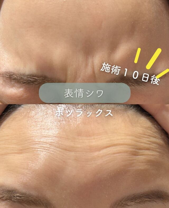 ✨
【額＋眉間ボツラックス施術から10日後の症例紹介】

施術後は、気になっていたシワがしっかりと改善され、おでこ全体がツルンと滑らかでとても美しい印象に✨
眉間の表情ジワも和らぎ、柔らかく穏やかな表情に変化されています。

額のみ・眉間のみの施術ももちろん可能ですが、額＋眉間を一緒に施術することで、相乗効果が生まれ、より自然で洗練された印象に仕上がります💆‍♀️💫
表情のバランスも整いやすく、よりナチュラルな若々しさを実感していただけます。

シワ予防・表情ジワ改善にご興味のある方は、ぜひお気軽にご相談ください🩵
～ボツラックスって何？～
表情ジワは日常生活で表情筋を動かすことにより、お顔の筋肉が鍛えられ形成されてしまいます。
ボツラックス注射は、神経毒を筋肉に注入することで、
小顔やシワ改善などの美容効果が期待できる治療法です。
たとえば、顔のエラ部分に注射することで、エラの筋肉の
ボリュームが減り、フェイスラインをスッキリとさせることができます。
その他では汗を抑えたり、肩こり改善が期待できる治療方法です。

💉ボツラックスの効果持続期間
個人差はありますが3～4ヶ月程度とされています。
注射を行ってから2〜3日程度で効果があらわれはじめ、徐々にシワや多汗症などが改善されて、1ヶ月かけて身体に馴染んでいきます。

3〜4ヶ月をピークに徐々に効果が薄れていき、治療から6ヶ月経つ頃には効果もなくなっていることがほとんどです。
ボツラックス注射の効果を維持するために、4〜6ヶ月に一回定期的に施術を受けることがお勧めです。

💉ボツラックス注射がおすすめな方
・エラが気になる
・フェイスラインをスッキリさせたい
・顔の表情ジワが気になる
・マッサージを受けても肩こりが治らない
・首から肩の華奢なラインに憧れる
・ワキガや多汗症で悩んでいる

■額or眉間or目尻or目の下or顎
各：6,000円
・カウンセリング+施術時間：30分
・施術中の痛み：チクっとした痛みあり
（※個人差あり）
（※表面麻酔希望の場合：+3,000円）
・ダウンタイム：内出血がでる場合もありますが、徐々に落ち着きます。
ボツラックスは熱に弱い為、薬剤が安定するまでの１週間は血行を促進させるサウナや岩盤浴などは控えてください。
・施術後のメイク：施術部位を避ければ当日から可能
・効果：表情ジワの改善、エラの改善、小顔効果、肩こり改善、多汗症の改善

■ボツラックス
ボツラックス（Botulax）は、韓国のHugel社が製造したA型ボツリヌス毒素を有効成分とする薬剤です。
承認状況：国内未承認
入手経路：PRSS社より入手
国内の承認医薬品などの有無：同一の成分や性能を有する他の国内承認医薬品等はありません
諸外国における安全性等に係る情報：韓国の食品医薬品安全庁（KFDA）

⚠️DMでのお問い合わせはお受けしておりません
お問い合わせは、クリニックへ直接お電話をお願いいたします🌱

————————————

ACCESS：大阪府大阪市北区茶屋町15-8
茶屋町ビル2階
TEL：06-6743-4652
営業時間：10時〜17時
(最終受付時間：16時)
お問合せ受付時間：10時〜19時

#美容皮膚科 #美容外科 #美容クリニック #エイジング #アンチエイジング #シワ #ボツラックス #ボトックス#デザインビューティクリニック#表情ジワ