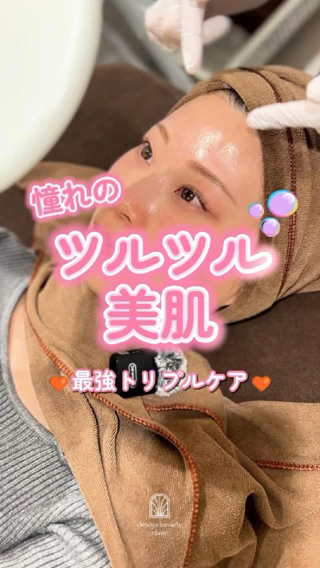 🫧
憧れの“つるつる美肌”💎✨最強トリプルケア🤍🤍🤍

毛穴のざらつき、くすみ、肌のゴワつき。
「スキンケアだけじゃ物足りない…」そんな声、増えてます😌

今回は、
✨ ストロボフェイシャル（ハイドラジェントル＋マッサージピール）
✨ ピコフラクショナル
✨ エレクトロポレーション

この3ステップで、
触れたくなる、なめらか肌を目指します🪞🫧

📷 各施術後のBefore/Afterもフィードにて公開中✔️
6月29日の投稿も要CHECK👀

🧡ストロボフェイシャル🧡
初回 19,600円（税込）
通常 25,000円（税込）
【ハイドラジェントル】
・施術中の痛み：ひりつきを伴う場合あり
・ダウンタイム： 赤みや熱感、痒み等の肌荒れが生じる場合あり
・施術後のメイク：当日からOK
・効果：黒ずみ・ざらつきの改善、肌のトーンアップ、ハリ・艶感アップ

【コラーゲンピール】
・施術中の痛み：ほとんどなし
・ダウンタイム：赤みや乾燥、痒み等の肌荒れが生じる場合あり
・施術後のメイク：当日からOK
・効果：赤ら顔、ハリツヤ、目元の小じわ、肌質改善

🩵ピコフラクショナル🩵
部分初回：7,900円
部分通常：12,750円
・カウンセリング＋施術時間：約１時間
・施術中の痛み：輪ゴムではじかれる感覚 、熱感あり
（※表面麻酔希望の場合：+ 3,000円）
・ダウンタイム：２～３日程度、
赤みやひりつき、点状出血等が生じる場合あり
・施術後のメイク：翌日からOK
・効果：毛穴の開き、ニキビ跡、ハリ、艶、小皺、肌質改善

💚エレクトロポレーション💚
初回：5,500円
通常：6,600円
・カウンセリング＋施術時間：約60分
・施術中の痛み：電流によるピリピリ感があります。（個人差があります）
・ダウンタイム：なし
・施術後のメイク：当日からOK
・効果：美容成分導入・保湿・鎮静

🧪追加薬剤オプション
各3,300円
⭐︎美白（ビタミンC＋トラネキサム酸）
⭐︎ニキビ（ビタミンC＋ビタミンB）
⭐︎エイジング（ビタミンE＋EMN）

上記オプションに➕550円で、
さらにビタミンCの追加が可能❤️

※全て税込価格

お問い合わせは、クリニックへ直接お電話をお願いいたします🌱
⚠️DMでのお問い合わせはお受けしておりません。

————————————

ACCESS：大阪府大阪市北区茶屋町15-8
茶屋町ビル2階
TEL：06-6743-4652
営業時間：10時〜17時（最終受付16時）
お問合せ受付時間：10時〜19時

#美容皮膚科 #美容外科 #美容クリニック #美肌 #美白 #アンチエイジング #肌質改善 #デザインビューティークリニック