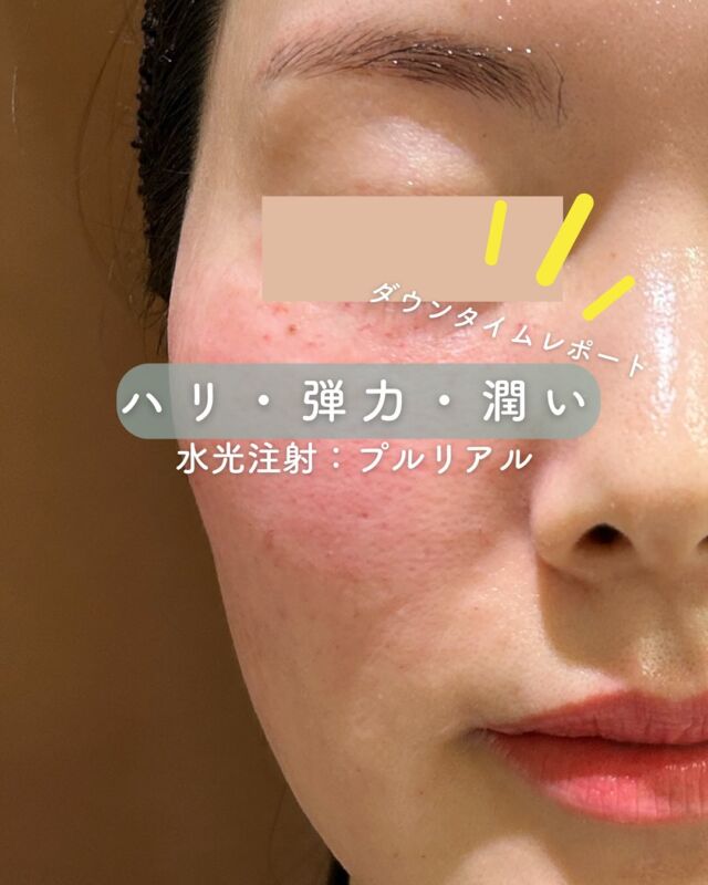 ✨
【プルリアル デンシファイ:水光注射📸 ダウンタイム経過レポート】

当院で水光注射に使用している、話題の《プルリアル デンシファイ（Pluryal Densify）》をご紹介します💉
ヨーロッパの厳しい基準をクリアした医療グレードのスキンブースターで、美容先進国でも高く評価されている製剤です💉

今回は、実際の施術後の経過を
【翌日→2日後→3日後→1週間後→2週間後】の症例写真でご紹介📷

🩵【ダウンタイムについて】
施術直後は赤みや点状の針跡が見られますが、多くの方が3日ほどで落ち着き始め、1週間後にはほとんど目立たない自然な肌に✨
2週間後には肌の内側からふっくらとしたハリや、うるおいのあるツヤ感を実感できます🪞

💎【プルリアル デンシファイの特徴】
・高濃度ヒアルロン酸＋アミノ酸複合成分配合
・コラーゲン密度の向上をサポート
・たるみ・小ジワ・乾燥が気になる肌に根本からアプローチ
・注入後も自然な仕上がりで表情の邪魔をしない
・敏感肌の方にも配慮された低刺激処方

🧡 特に「年齢肌によるボリュームロス」や「うるおい不足」にお悩みの方におすすめ。
当院では、専用の9本針を使った「ハイコックス水光注射」で、製剤を均一かつ浅層に丁寧に届けています。

🗓️ 気になるダウンタイムも、今回の症例写真でしっかりご確認いただけます。自然に美しく整う肌を、ぜひ体感してみてください🌿

〜プルリアルって何？〜
プルリアルは、ヒアルロン酸をベースにアミノ酸やミネラルなどを豊富に含んだ“肌育注射”。
肌再生を促し、ハリ・ツヤ・弾力・乾燥小じわの改善を目指すスキンブースターです✨

〜ハイコックス（水光注射）のメリット・特徴〜
・専用機器で均一な深さ・量をスピーディーに注入
・全体にまんべんなく広がることでムラが少なく、仕上がりがなめらか
・施術直後は点状の赤みや針跡が出ることもありますが、比較的ダウンタイムは軽めです

【プルリアル】
プルリアルは
『ドクター手打ち』と『ハイコックス（水光注射機器）』の
2種類の方法からお選びいただけます❣️

■ドクター手打ち（全顔2cc）
77,000円

■ハイコックス(水光注射機器)（全顔2cc）
52,000円

※各施術、別途麻酔代3,000円

・カウンセリング＋施術時間：約1〜1.5時間
・施術中の痛み：チクっとした痛み、熱感あり（※表面麻酔使用）
・ダウンタイム：赤み、凹凸感、内出血が2～7日程度出る場合あり

■プルリアルについて
承認状況：国内未承認
国内の承認医薬品の有無：同一の成分・性能を有する他の国内承認医薬品等はありません
諸外国における安全性情報：CE認証

⚠️DMでのお問い合わせはお受けしておりません。
お問い合わせは、クリニックへ直接お電話をお願いいたします🌱

————————————

ACCESS：大阪府大阪市北区茶屋町15-8
茶屋町ビル2階
TEL：06-6743-4652
営業時間：10時〜17時（最終受付16時）
お問合せ受付時間：10時〜19時

#プルリアルデンシファイ #水光注射 #ハイコックス #スキンブースター #ヒアルロン酸注射 #エイジングケア #肌の再構築 #ダウンタイムレポート #美容クリニック症例 #肌質改善 #美肌治療