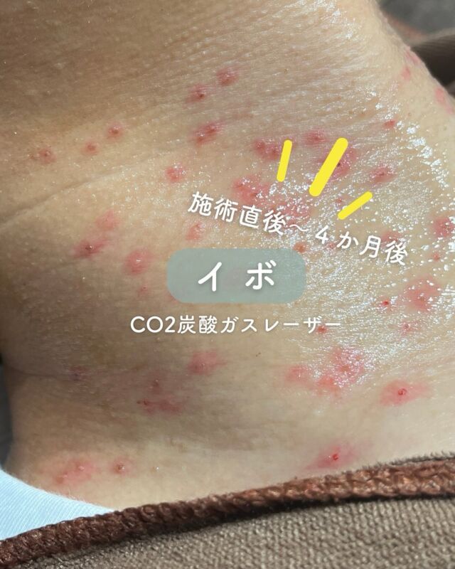 📸
【CO2レーザーによるイボ除去症例👨‍⚕️✨】
⁠
＼男性の首元もここまで変わる！／
本日は、CO2ガスレーザーを使用したイボ除去の症例をご紹介いたします💡
⁠
📸写真は【施術前→施術直後→4か月後】の経過です。
⁠
施術を受けられたのは、首元のイボが気になっていた男性の方。
レーザーによる丁寧な処置で、肌表面がなめらかに整い、見た目の清潔感がぐんとアップ✨
⁠
4か月後には、傷跡もほとんど目立たず、若々しく健康的な印象に！
⁠
そんなお悩みをお持ちの方には、CO2レーザー治療がおすすめです😊

✔ イボをピンポイントで除去
✔ 徐々に赤みが引いて自然な肌に
✔ 見た目の印象がすっきり明るく✨

～CO2炭酸ガスレーザーって何？～
CO2レーザーは、水分に反応する特性を活かし、
イボやほくろの除去に適したレーザー治療です。
照射部分の細胞内水分を瞬間的に蒸散させて皮膚を削り、
熱凝固作用で出血を最小限に抑えます。
皮膚表面だけに作用するため、治癒も比較的早く、傷跡も目立ちにくいのが特徴です✨

～こんな方におすすめ～
・首や顔のイボが気になる
・見た目の印象をすっきりさせたい
・再発を防ぎつつきれいに取りたい
・痛みや出血を最小限に抑えたい

【料金案内】
☆1～5個：5,500円／個
☆6～10個：11,000円／個
☆軟膏1本：700円
※別途麻酔代：3,000円

・カウンセリング＋施術時間：約1時間
・施術中の痛み：表面麻酔使用のため、痛みはほとんどありません（個人差あり）
・ダウンタイム：2週間程度、軟膏の塗布が必要
・施術後のメイク：患部を避ければ当日からOK

⚠️DMでのお問い合わせはお受けしておりません。
お問い合わせは、クリニックへ直接お電話をお願いいたします🌱

————————————

ACCESS：大阪府大阪市北区茶屋町15-8
茶屋町ビル2階
TEL：06-6743-4652
営業時間：10時〜17時（最終受付16時）
お問合せ受付時間：10時〜19時

#イボ取り #ほくろ除去 #CO2レーザー #炭酸ガスレーザー #イボ除去 #首イボ #肌トラブル改善 #美容皮膚科 #デザインビューティークリニック