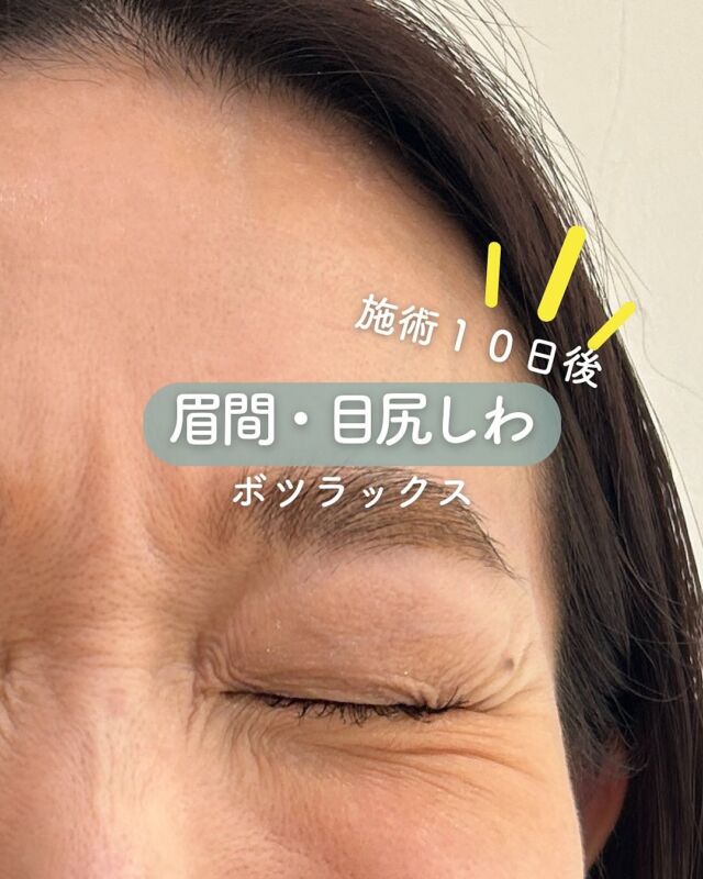 ✨
【ボツラックス施術10日後の症例紹介】
今回は「眉間＋目尻」へ同時にボツラックスを注入されたお客様の、10日後のお写真をご紹介します📸

しっかりと刻まれていた眉間と目尻の表情ジワが、ぐっとやわらいでいるのがお分かりいただけるかと思います😊
特に眉間のシワは、疲れて見えたり、怒っているような印象を与えがちですが、表情が柔らかくなることで、ぐっと若々しく優しい印象に✨

👀 眉間と目尻を同時に施術することで得られるメリット
✔ 表情全体がバランスよく自然に若返る
✔ 片方だけの施術よりも“違和感のない仕上がり”に
✔ 筋肉の連動性を考えたトータルケアが可能に
✔ 予防的な効果も◎

「ここだけじゃなく、あっちも気になる...」という方には、同時施術がおすすめです💡
お一人おひとりのお悩みに合わせて、最適なご提案をさせていただきます✨
シワ予防・表情ジワ改善にご興味のある方は、ぜひお気軽にご相談ください🩵

～ボツラックスって何？～
表情ジワは日常生活で表情筋を動かすことにより、お顔の筋肉が鍛えられ形成されてしまいます。
ボツラックス注射は、神経毒を筋肉に注入することで、
小顔やシワ改善などの美容効果が期待できる治療法です。
たとえば、顔のエラ部分に注射することで、エラの筋肉の
ボリュームが減り、フェイスラインをスッキリとさせることができます。
その他では汗を抑えたり、肩こり改善が期待できる治療方法です。

💉ボツラックスの効果持続期間
個人差はありますが3～4ヶ月程度とされています。
注射を行ってから2〜3日程度で効果があらわれはじめ、徐々にシワや多汗症などが改善されて、1ヶ月かけて身体に馴染んでいきます。

3〜4ヶ月をピークに徐々に効果が薄れていき、治療から6ヶ月経つ頃には効果もなくなっていることがほとんどです。
ボツラックス注射の効果を維持するために、4〜6ヶ月に一回定期的に施術を受けることがお勧めです。

💉ボツラックス注射がおすすめな方
・エラが気になる
・フェイスラインをスッキリさせたい
・顔の表情ジワが気になる
・マッサージを受けても肩こりが治らない
・首から肩の華奢なラインに憧れる
・ワキガや多汗症で悩んでいる

■額or眉間or目尻or目の下or顎
各：6,000円
・カウンセリング+施術時間：30分
・施術中の痛み：チクっとした痛みあり
（※個人差あり）
（※表面麻酔希望の場合：+3,000円）
・ダウンタイム：内出血がでる場合もありますが、徐々に落ち着きます。
ボツラックスは熱に弱い為、薬剤が安定するまでの１週間は血行を促進させるサウナや岩盤浴などは控えてください。
・施術後のメイク：施術部位を避ければ当日から可能
・効果：表情ジワの改善、エラの改善、小顔効果、肩こり改善、多汗症の改善

■ボツラックス
ボツラックス（Botulax）は、韓国のHugel社が製造したA型ボツリヌス毒素を有効成分とする薬剤です。
承認状況：国内未承認
入手経路：PRSS社より入手
国内の承認医薬品などの有無：同一の成分や性能を有する他の国内承認医薬品等はありません
諸外国における安全性等に係る情報：韓国の食品医薬品安全庁（KFDA）

⚠️DMでのお問い合わせはお受けしておりません
お問い合わせは、クリニックへ直接お電話をお願いいたします🌱

————————————

ACCESS：大阪府大阪市北区茶屋町15-8
茶屋町ビル2階
TEL：06-6743-4652
営業時間：10時〜17時
(最終受付時間：16時)
お問合せ受付時間：10時〜19時

#美容皮膚科 #美容外科 #美容クリニック #エイジング #アンチエイジング #シワ #ボツラックス #ボトックス#デザインビューティクリニック#表情ジワ