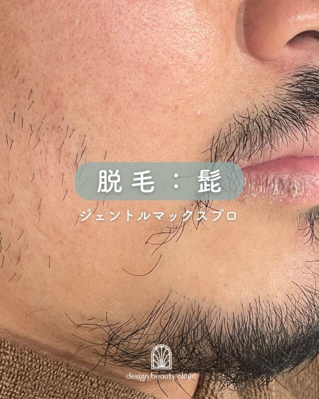 📸
【男性ひげ（顔）脱毛✨症例紹介】

こちらは、男性ひげ脱毛の施術直後と2か月後の症例写真です📸

施術直後は、毛が一時的に浮き出たように見えることもありますが、これは正常な反応です。時間の経過とともに自然と抜け落ち、写真のように毛量が徐々に減っていきます。

また、脱毛を回数を重ねることで、生えてくる毛質も少しずつ変化していきます。太く硬かった毛が、だんだんと柔らかく、細くなっていくため、お肌への負担も軽減されていきます☺️

ひげ剃りの頻度が減ることで、肌荒れやカミソリ負けの改善にもつながりますよ✨

男性のひげ脱毛は、見た目の清潔感はもちろん、毎日のケアの負担軽減にも効果的です。

気になる方はぜひ、お気軽にご相談ください😊

～脱毛がおすすめの方～
・自己処理後の毛穴のポツポツが気になる方
・自己処理が面倒な方
・脱毛と同時に美肌を目指したい方

☆全顔初回：12,000円
☆全顔通常：16,500円
・カウンセリング＋施術時間：施術部位によって異なります
・施術中の痛み：個人差がありますが、我慢できる程度です（必要時表面麻酔使用可能）
・ダウンタイム：２～３日程度、赤みやひりつき、点状出血等が生じる場合あり
・施術後のメイク：当日からOK

⚠️DMでのお問い合わせはお受けしておりません
お問い合わせは、クリニックへ直接お電話をお願いいたします🌱

————————————

ACCESS：大阪府大阪市北区茶屋町15-8
茶屋町ビル2階
TEL：06-6743-4652
営業時間：10時〜17時
(最終受付時間：16時)
お問合せ受付時間：10時〜19時

#美容皮膚科 #美容外科 #美容クリニック #脱毛 #髭脱毛 #美肌