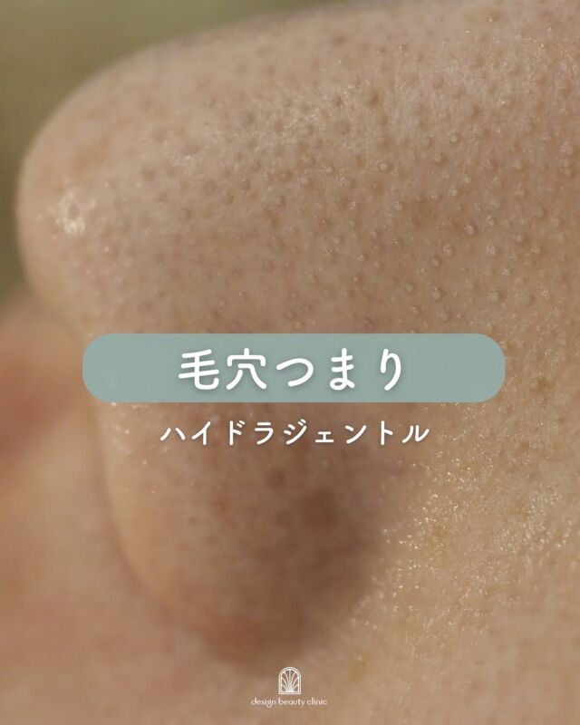 ☀️
【夏の毛穴ケア✨大本命】
こちらは、ハイドラジェントルの施術前 → ポアレス後 → 施術後のお写真です📸

ポアレスでは、毛穴の奥の汚れがしっかり浮き出ているのがわかりますね！
💡当院ではこのポアレス、オプション料金なしでご提供しております💡

ハイドラジェントルで汚れをしっかり洗浄した後は、レーザーや導入を組み合わせることで、熱の力で毛穴がキュッと引き締まり、さらに効果を実感していただけます◎
水光注射前にも大変おススメです💮

毛穴の開きや黒ずみが気になる方は、ぜひ一度ご相談ください🧖‍♀️✨
美肌への第一歩を一緒にサポートします😊

～ハイドラジェントルってなに？～
ハイドラジェントルとは、特殊な水流の力と２種類のピーリング剤を使用し、肌や毛穴の汚れを取るウォーターピーリングマシンです。
水溶性のピーリング剤(AHA)でお肌の汚れや古い角質を除去した後、油溶性のピーリング剤(BHA)で毛穴の黒ずみや角栓を除去していきます。
このピーリング剤をお肌に噴射させながら汚れを吸引していくので、お肌に負担をかけずに不要な角質や毛穴詰まりを取り除くことができます。
施術後はメイクもしていただけるので気軽に受けていただけます。
毛穴の詰まりや開き・黒ずみ・ニキビやオイリー肌など、
お肌に悩みをお持ちの方には是非一度受けていただきたいオススメの施術です♪

☆水溶性ピーリング剤（AHA)
乳酸やグリコール酸を主成分とした水溶性のピーリング剤で、角質に作用し毛穴の汚れや老廃物除去、角質を除去します。
AHAは柑橘類やリンゴなどに含まれる天然由来の成分です♪

☆油溶性ピーリング剤（BHA)
サリチル酸、ラクトビオン酸を主成分としたピーリング剤で、毛穴の奥深くまで行き届き、毛穴の黒ずみを除去します。
AHAは皮膚表面の角質に作用しますが、BHAは毛穴の皮脂を溶かし、毛穴の汚れや角栓を除去します♪

～ハイドラジェントルがお勧めの方～
・毛穴の黒ずみを改善したい方
・脂性肌や毛穴の開きを改善したい方
・肌のざらつきが気になる方
・肌に透明感を出したい方
・肌のくすみが気になる方
・ニキビにお悩みの方

★初回全顔：9,800円
★通常全顔：13,800円

・カウンセリング＋施術時間： 30分
・施術中の痛み：ひりつきを伴う場合あり
・ダウンタイム： 赤みや熱感、痒み等の肌荒れが生じる場合あり
・施術後のメイク：当日からOK
・効果：黒ずみ・ざらつきの改善、肌のトーンアップ、ハリ・艶感アップ

————————————

ACCESS：大阪府大阪市北区茶屋町15-8
茶屋町ビル2階
TEL：06-6743-4652
営業時間：10時〜17時
(最終受付時間：16時)
お問合せ受付時間：10時〜19時

#design beauty clinic #デザインビューティークリニック #美容皮膚科 #美容外科 #ハイドラジェントル #ハイドラジェントル効果 #美肌治療 #肌ケア #透明感アップ #美容外科 #エイジングケア #スキンケア #アンチエイジング #美肌革命