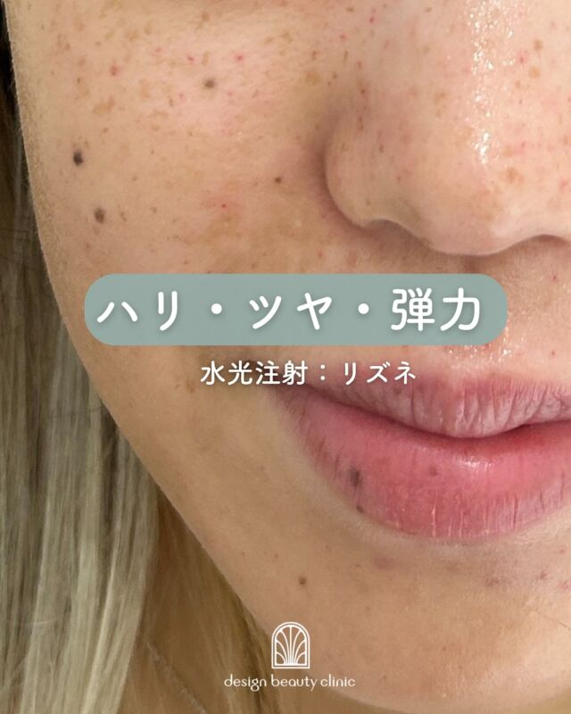 🤍
【リズネ症例紹介】📸

施術前▶️施術直後の様子です！

ハイコックスは複数の極細針で注入するため、施術直後は点状の赤みが出ます。
「水玉模様」のような跡は、しっかりお肌にアプローチできた証しです✨

✔ 肌の内側からふっくらとしたハリ感を実感
✔ 自然な仕上がりで美肌に✨
✔ 肌状態に合わせた丁寧な注入が可能💉

～リズネって何？～
リズネは、損傷した肌細胞の再生を促し、ハリ・ツヤ・うるおいを高める“肌育注射”です。
リジュランの後発品として、コストを抑えながらも同等の効果が期待できます✨
『ドクター手打ち』と『ハイコックス（水光注射機器）』、2種類の方法から選択可能です💆‍♀️

～リズネがおすすめな方～
・毛穴の開きや小じわが気になる
・肌のハリや弾力が低下してきた
・凹凸やちりめんじわを改善したい
・お肌の内側からの再生を目指したい

～ハイコックス(水光注射機器)のメリット～
・均一かつスピーディーな薬剤注入が可能
・肌全体をムラなくアプローチ
・施術中の痛み・内出血が出にくく、ダウンタイムも少なめ

当院では韓国で人気の水光注射機器【ハイコックス】を使用✨
薬剤のロスが少なく、痛みも少ないので、初めての方にもおすすめです♪

【リズネ】
リズネは
『ドクター手打ち』と『ハイコックス（水光注射機器）』の
2種類の打ち方からお選びいただけます❣️

■ドクター手打ち（全顔2cc）
通常：57,000円

■ハイコックス（水光注射機器）（全顔2cc）
初回：32,000円
通常：41,000円
3回コース：96,000円

・カウンセリング＋施術時間：約1時間
・施術中の痛み：チクっとした痛み、熱感あり（※表面麻酔使用）
・ダウンタイム：赤み、凹凸感、内出血が2～7日程度出る場合あり

■リズネについて
承認状況：国内未承認
入手経路：ARM社より入手
国内の承認医薬品などの有無：同一の成分や性能を有する他の国内承認医薬品等はありません
諸外国における安全性等に係る情報：韓国の食品医薬品安全庁（KFDA）の承認びCE認証

⚠️DMでのお問い合わせはお受けしておりません。
お問い合わせは、クリニックへ直接お電話をお願いいたします🌱

————————————

ACCESS：大阪府大阪市北区茶屋町15-8
茶屋町ビル2階
TEL：06-6743-4652
営業時間：10時〜17時（最終受付16時）
お問合せ受付時間：10時〜19時

#リズネ #肌育注射 #水光注射 #スキンブースター #ハリ肌 #ツヤ肌 #毛穴改善 #リジュラン #韓国美容 #美容皮膚科 #デザインビューティークリニック
