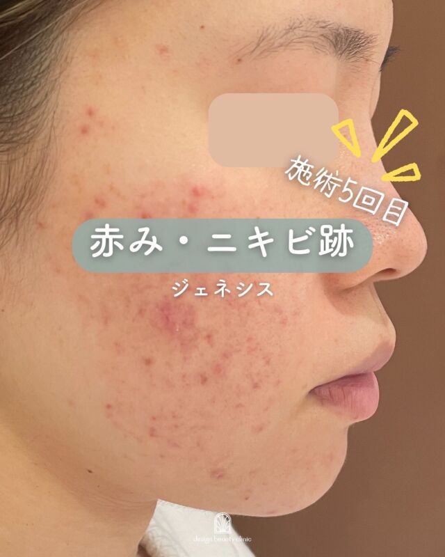 📸
【ニキビ跡の赤みが気になる方へ📢】
⁡
本日は、ジェネシスを5回受けられた患者様の症例写真をご紹介します📸✨
⁡
写真でも分かるように、施術を重ねるごとに赤みが少しずつ落ち着いてきています。
ジェネシスは肌表面にダメージを与えず、真皮層の血管やコラーゲンにアプローチするレーザー治療です。
⁡
特に、ニキビ跡の赤みや肌のキメの乱れ、毛穴が気になる方におすすめの治療です💡
⁡
🔸ジェネシスは1回でも効果を実感される方もいらっしゃいますが、より安定した効果を得るためには複数回の施術が必要になります。
当院では、患者様の肌状態に合わせて、無理のないペースで継続的な治療をご提案しています😊
⁡
「すぐに消えるの？」と不安な方も、まずはカウンセリングでお肌の状態を一緒に確認しましょう🪞

～ジェネシスって何？～
ジェネシスは、１施術で何役もこなす多彩な効果を持つため、いくつかの複合的な肌のお悩みにアプローチ出来ます。
主な効果はこちらになります。
・レーザーピーリング効果により、悪化したニキビやニキビ跡の改善を
促し、毛穴の引き締めにも効果的ターンオーバーの乱れを正常な状態に近づける事によって、色素沈着の
改善や、シミのやくすみの改善
・真皮層に位置する微小血管を加熱し、血管壁や赤血球を破壊することによって、赤ら顔や毛細血管拡張症の改善
・真皮層に働きかけることでコラーゲンの生成を促し、ハリのあるきめ細やかな肌を作る

マイルドなレーザーのため、体感としては温かい熱のシャワーを
浴びているような感覚で、照射時は痛みがほとんどありません。
☆初回3000shot：7,800円
☆通常3000shot：10,800円
☆初回6000shot：13,600円
☆通常6000shot：18,800円
・カウンセリング＋施術時間： 45分～60分
・施術中の痛み：ほとんどなし
・ダウンタイム： 赤みや熱感、痒み等の肌荒れが生じる場合あり
・施術後のメイク：当日からOK
・効果：赤ら顔、ハリツヤ、ニキビ痕の赤み、ニキビ痕の色素沈着、肌のキメなどの肌質改善

⚠️DMでのお問い合わせはお受けしておりません
お問い合わせは、クリニックへ直接お電話をお願いいたします🌱

-———————————

ACCESS：大阪府大阪市北区茶屋町15-8
茶屋町ビル2階
TEL：06-6743-4652
営業時間：10時〜17時
(最終受付時間：16時)
お問合せ受付時間：10時〜19時

#美容皮膚科 #美容外科 #美容クリニック #美肌 #女医 #ニキビ跡 #ニキビ痕 #保湿 #エイジングケア #肌質改善#ジェネシス#デザインビューティークリニック