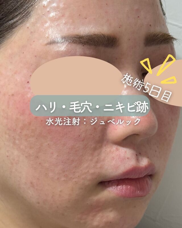 ✨
【水光注射《ジュベルック》の症例写真】

今回は、水光注射「ジュベルック」施術直後と5日目の比較写真をご紹介いたします😊

📷左：施術直後
赤みや軽い凹凸感が見られますが、これは一時的な反応で多くの方に見られる正常な経過です。

📷右：施術5日目
赤みや凹凸も落ち着き、お肌全体がなめらかに✨
内側からふっくらとしたハリ感や透明感を感じていただける頃です💎

💡「ジュベルック」は、肌再生を促す新しいアプローチの水光注射で、ニキビ跡・毛穴・肌のハリ感UPなどに効果的です。

施術後のダウンタイムが気になる方も、日々の変化を知ることで安心して受けていただけます😊

✔ 肌の内側からふっくらハリ感
✔ 毛穴・ちりめんジワ・凹凸肌に
✔ ダウンタイム少なめで透明肌へ✨

～ジュベルックって何？～
ジュベルックは、肌の再生を促し、毛穴や小じわ、ハリ不足を改善する肌育注射です。
『ドクター手打ち』と『水光注射機器』、お好みの方法で施術可能です💆‍♀️✨

～ジュベルックがおすすめな方～
・毛穴の開きや肌の凹凸が気になる
・ハリや弾力の低下を感じる
・ツヤのあるなめらかな肌を目指したい
・小じわやちりめんじわが気になる

～ハイコックス(水光注射機器)のメリット～
・均一かつスピーディーな薬剤注入が可能
・肌全体をムラなくアプローチ
・施術中の痛み・内出血が出にくく、ダウンタイムも少なめ

当院では韓国で人気の水光注射機器【ハイコックス】を使用✨
薬剤のロスが少なく、痛みも少ないので、初めての方にもおすすめです♪

【ジュベルック】
ジュベルックは
『ドクター手打ち』と『ハイコックス(水光注射機器)』の
2種類か打ち方を選べます❣️

■ドクター手打ち（全顔3cc）
通常：57,000円

■ハイコックス(水光注射機器)（全顔3cc）
初回：32,000円

通常：41,000円
3回コース：96,000円

・カウンセリング＋施術時間：約1時間
・施術中の痛み：チクっとした痛み、熱感あり
・ダウンタイム：赤み、凹凸感、内出血が2～7日程度出る場合あり

■ジュベルックについて
承認状況：国内未承認
入手経路：ネイチャーフォース・ジャパン社より入手
国内の承認医薬品の有無：同一の成分・性能を有する国内承認医薬品等はありません
諸外国における安全性情報：米国FDA・韓国KFDA承認

⚠️DMでのお問い合わせはお受けしておりません。
お問い合わせは、クリニックへ直接お電話をお願いいたします🌱

————————————

ACCESS：大阪府大阪市北区茶屋町15-8
茶屋町ビル2階
TEL：06-6743-4652
営業時間：10時〜17時（最終受付16時）
お問合せ受付時間：10時〜19時

#ジュベルック #水光注射 #ハイコックス #肌育注射 #コラーゲン生成 #ツヤ肌 #毛穴改善 #スキンブースター #美容皮膚科 #デザインビューティークリニック