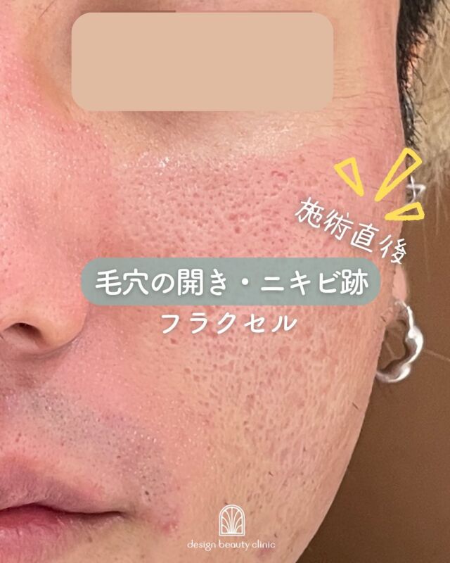 📸
【フラクセル施術直後のお写真】
こちらはフラクセルレーザー施術直後のお肌の様子です。
施術直後は赤みが目立つことがありますが、これは正常な反応ですのでご安心ください😊

⏳【ダウンタイムについて】
赤みや軽いヒリつきが数日間続くことがあり、ダウンタイムはおおよそ1週間程度です。
その間は、保湿と紫外線対策をしっかりと行っていただくことが大切です☀️💧

✨フラクセルは、お肌の再生を促し、毛穴・ニキビ跡・小ジワ・くすみなどにアプローチする人気の美肌治療です。
ご不安な点がありましたら、お気軽にご相談くださいね😊

〜フラクセルって何？〜

毛穴やニキビ痕などのトラブルを抱えた肌を
『新しい肌へと入れ替える』ことを目的とした治療です。
高出力のレーザーを目に見えない程の微小な点状に照射し、熱エネルギーを与えながら細胞再生を促し、
１回の治療で皮膚の５%～15％程度を入れ替えていきます。
熱エネルギーは真皮層まで作用する為、コラーゲンやエラスチンを再構築し、真皮層の傷痕や、年齢とともに増えてくる小じわ、肌のタイトニング等の効果も期待できます。

～フラクセルがおすすめの方～
・凹凸の大きいニキビ痕が気になる方
・毛穴の開きが気になる方
・小じわが気になる方
・肌質改善したい方

☆全顔初回：19,800円
☆全顔通常：28,800円
☆鼻or頬初回：9.900円
☆鼻or頬通常：14.400円

・カウンセリング＋施術時間： 1時間
・施術中の痛み：表面麻酔を使用しますが熱感や火照り、痛みを伴います 
・ダウンタイム：2、３日から1週間前後、赤み・火照り・痒み・肌のツッパリ感・皮むけ等の症状が伴う可能性あり。
・施術後のメイク：３日後から可能だが、赤みや皮むけが落ち着いてからがおすすめ
・効果：ニキビ痕の凹凸の改善、毛穴の引き締め、肌質改善

————————————

ACCESS：大阪府大阪市北区茶屋町15-8
茶屋町ビル2階
TEL：06-6743-4652
営業時間：10時〜17時
(最終受付時間：16時)
お問合せ受付時間：10時〜19時

#美容皮膚科 #美容外科 #大阪美容クリニック#梅田美容クリニック#フラクセル#毛穴撲滅#ニキビ跡#クレーター