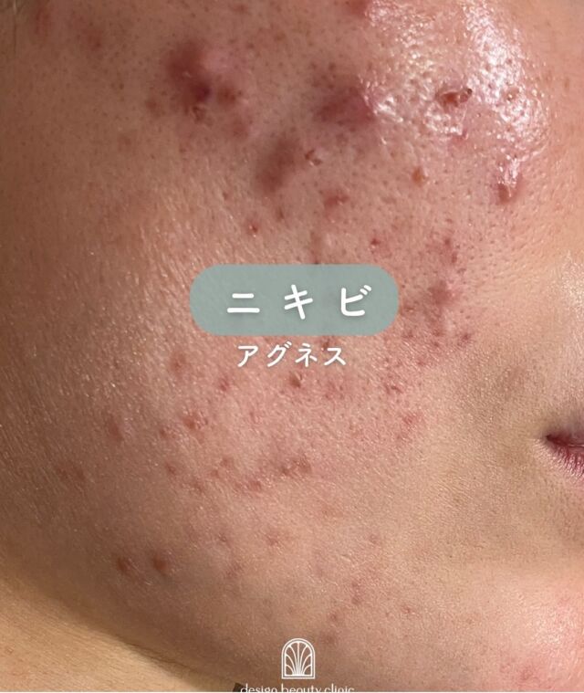 📷
【症例紹介｜アグネス2回目施術後のお肌の変化✨】

こちらは、**アグネス2回目施術後（3回目施術前）**の患者さまのお写真です📸
施術前には炎症を伴うニキビが多く見られましたが、2回目の施術後には、赤みや腫れがしっかりと落ち着き、お肌全体のトーンも明るくなっています👏💫

💡アグネス（AGNES）とは？
皮脂腺そのものにアプローチし、繰り返すニキビの「根本原因」に働きかける最新のニキビ治療です。
薬や一時的なケアでは改善しにくい、しつこい炎症性ニキビや繰り返す大人ニキビでお悩みの方におすすめです🌿

🔍アグネスはこんな方におすすめ！
・何度も同じ場所にニキビができてしまう
・痛みや赤みを伴うニキビがなかなか引かない
・皮膚科や市販薬では改善が難しかった
・ニキビ痕を残したくない方

～アグネスって何？～
アグネスは、選択的に皮脂腺を破壊することで、
ニキビの原因を根本から治療する本質的なニキビ治療治療です。
「毛根を破壊して脱毛ができる」のと同様に、
破壊された皮脂腺は再生せず、長期的なニキビ予防効果が期待できます💥

当院では施術前にしっかりとカウンセリングを行い、
生活習慣やスキンケアの見直しもサポート✨
肌に合った基礎化粧品やインナーケアもご提案しています♪

🗓1回の施術でも効果を実感される方が多く、数回の施術で肌質そのものが変わってきた！という嬉しいお声も✨

また、ジェネシス（ニキビ痕・赤みケア）治療と併用することで相乗効果が高まります🌟

【料金案内】
アグネス
☆全顔初回：39,800円
☆全顔通常：59,800円
☆部分初回：10,800円
☆部分通常：16,500円
※麻酔代別途：3,000円
※汗管腫の施術は上記とは異なる料金設定です

・カウンセリング＋施術時間：約1時間
・施術中の痛み：表面麻酔を使用します
・ダウンタイム：1週間前後、赤み・腫れ・熱感が生じる場合あり（個人差あり）
・施術後のメイク：術後3日以降から可能
・効果：ニキビ、汗管腫への改善

⚠️DMでのお問い合わせはお受けしておりません。
お問い合わせは、クリニックへ直接お電話をお願いいたします🌱

————————————

ACCESS：大阪府大阪市北区茶屋町15-8
茶屋町ビル2階
TEL：06-6743-4652
営業時間：10時〜17時（最終受付16時）
お問合せ受付時間：10時〜19時

#アグネス #ニキビ治療 #繰り返すニキビ #口周りニキビ #皮脂腺破壊 #汗管腫 #美容皮膚科 #ダウンタイム経過 #ニキビ跡予防 #ニキビ治療経過#デザインビューティークリニック#サリチル酸ピーリング