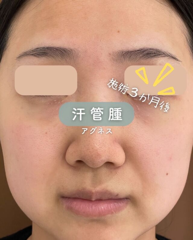 💠
【汗管腫（かんかんしゅ）アグネス施術・3カ月後の症例】

こちらは、汗管腫に対してアグネス治療を行った患者様の施術から3カ月後の症例写真です📷✨

1回の施術でも、症状が落ち着いているのがはっきりと分かります😊
小さなふくらみが目立ちにくくなり、肌の質感もなめらかに整っています。

施術直後はかなり赤みが出る方が多いですが、時間の経過と共に徐々に治まります♪

💡アグネス治療
専用の高周波機器を使用し、汗管腫の原因となる皮膚の一部にピンポイントでアプローチ。

汗管腫は、目元まわりにできやすく、「メイクでも隠れにくい…」とお悩みの方も多い症状です。
お一人おひとりのお肌の状態に合わせて、丁寧にご提案させていただきます🌿

☆初回 3×5㎝：21,600円
☆通常 3×5㎝：33,000円
・カウンセリング＋施術時間：約１時間
・施術中の痛み：表面麻酔使用
・ダウンタイム：１週間前後赤みや腫れ、熱感が生じる場合あり（個人差があります）
・施術後のメイク：術後３日以降～OK
・効果：汗管腫・ニキビ

～アグネスがおすすめの方～
・慢性的なニキビにお悩みの方
・ピーリング施術に効果を実感できなかった方
・処方薬を使用しても改善しなかった方
・レーザー施術で取り切れなかった汗管腫にお悩みの方

———————————

ACCESS：大阪府大阪市北区茶屋町15-8
茶屋町ビル2階
TEL：06-6743-4652
営業時間：10時〜17時
(最終受付時間：16時)
お問合せ受付時間：10時〜19時

⚠️DMでのお問い合わせはお受けしておりません
お問い合わせは、クリニックへ直接お電話をお願いいたします🌱

#美容皮膚科 #美容外科 #美容クリニック #汗菅腫 #アグネス #イボ#デザインビューティークリニック