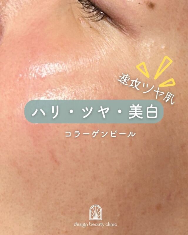 📸
【✨コラーゲンピール施術直後のお写真✨】

こちらは、コラーゲンピール施術直後のお写真です📸
ご覧いただくと分かるように、お肌にハリ・ツヤがすぐに現れているのが特徴です😊💕

コラーゲンピールは、お肌の内側からコラーゲンの生成を促進し、
くすみ・たるみ・小ジワなどにアプローチ。
さらに、美白効果も期待できるため、透明感のある明るいお肌へ導いてくれる人気の施術です✨

💎「今すぐにツヤ肌が欲しい！」
💎「肌のトーンアップもしたい！」
💎「大切な予定の前に肌を整えたい！」

そんな方にとてもおすすめです🌿
ダウンタイムも少なく、施術後すぐにメイクも可能なので、
忙しい毎日を送る方にもぴったりです💄

※「マッサージピール」という名前でも知られています。

気になる方は、ぜひお気軽にご相談ください😊
皆さまのお肌の美しさを最大限に引き出すお手伝いをいたします🌸

～コラーゲンピールとは？～
コラーゲンピールは、従来のケミカルピーリングと異なり、
皮膚を剥離せずに真皮層に作用してコラーゲンを生成を促し、赤ら顔、ハリツヤ、目元の小じわ、肌質改善の効果が期待できます。

・施術中の痛み：ほとんどなし
・ダウンタイム：赤みや乾燥、痒み等の肌荒れが生じる場合あり
・施術後のメイク：当日からOK
・効果：赤ら顔、ハリツヤ、目元の小じわ、肌質改善

●価格（全顔）
初回9,800円
通常15,800円
平日3回コース　29,400円
全日3回コース　39,400円
※全て税込価格
——————————

ACCESS：大阪府大阪市北区茶屋町15-8
茶屋町ビル2階
TEL：06-6743-4652
営業時間：10時〜17時
(最終受付時間：16時)
お問合せ受付時間：10時〜19時

#美容皮膚科 #美容外科 #美容クリニック #美肌 #女医 #美白 #アンチエイジング #シミ取り #レーザートーニング #肌質改善 #しみ #マッサージピール
#コラーゲンピール