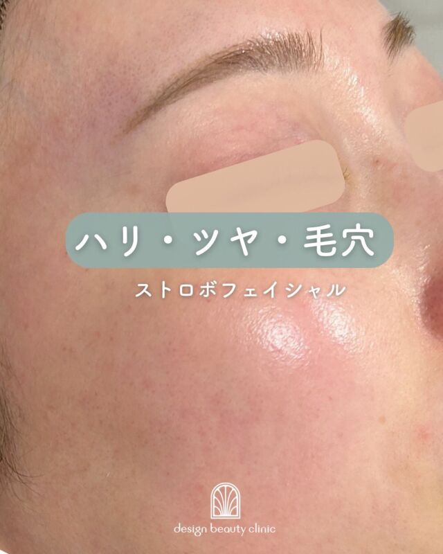 ✨
【症例紹介】ストロボフェイシャルでハリ・ツヤ爆誕
＼施術前→ハイドラジェントル後→コラーゲンピール後（全施術後）📸／

お肌の透明感・ハリ感・ツヤ感を同時に叶える、当院人気の【ストロボフェイシャル】✨

この方は、
🔹まず「ハイドラジェントル」で毛穴の奥の汚れや古い角質をやさしくオフ
🔹続いて「コラーゲンピール」で肌の内側からふっくら弾力＆美白ケア
を行いました。

全施術後のお写真では、
施術前と比べてお肌がパッと明るく、内側から発光するようなツヤ肌に💎
まさに“ストロボを焚いたような輝き”が誕生しています！

✔お肌のくすみ
✔毛穴の開き
✔ハリ不足
✔乾燥によるごわつき
などが気になる方に、特におすすめです💡

一度の施術でも違いを実感していただけますが、定期的なケアでさらに美肌をキープできます😊

◼️ストロボフェイシャル価格

初回 19,600円（税込）
通常 25,000円（税込）

【ハイドラジェントル】
・施術中の痛み：ひりつきを伴う場合あり
・ダウンタイム： 赤みや熱感、痒み等の肌荒れが生じる場合あり
・施術後のメイク：当日からOK
・効果：黒ずみ・ざらつきの改善、肌のトーンアップ、ハリ・艶感アップ

【コラーゲンピール】
・施術中の痛み：ほとんどなし
・ダウンタイム：赤みや乾燥、痒み等の肌荒れが生じる場合あり
・施術後のメイク：当日からOK
・効果：赤ら顔、ハリツヤ、目元の小じわ、肌質改善

-———————————

ACCESS：大阪府大阪市北区茶屋町15-8
茶屋町ビル2階
TEL：06-6743-4652
営業時間：10時〜17時
(最終受付時間：16時)
お問合せ受付時間：10時〜19時

#美容皮膚科 #美容外科 #美容クリニック #ストロボフェイシャル #ハイドラジェントル #ハイドラフェイシャル #コラーゲンピール #マッサージピール #毛穴撲滅 #毛穴治療 #毛穴洗浄 #ピーリング